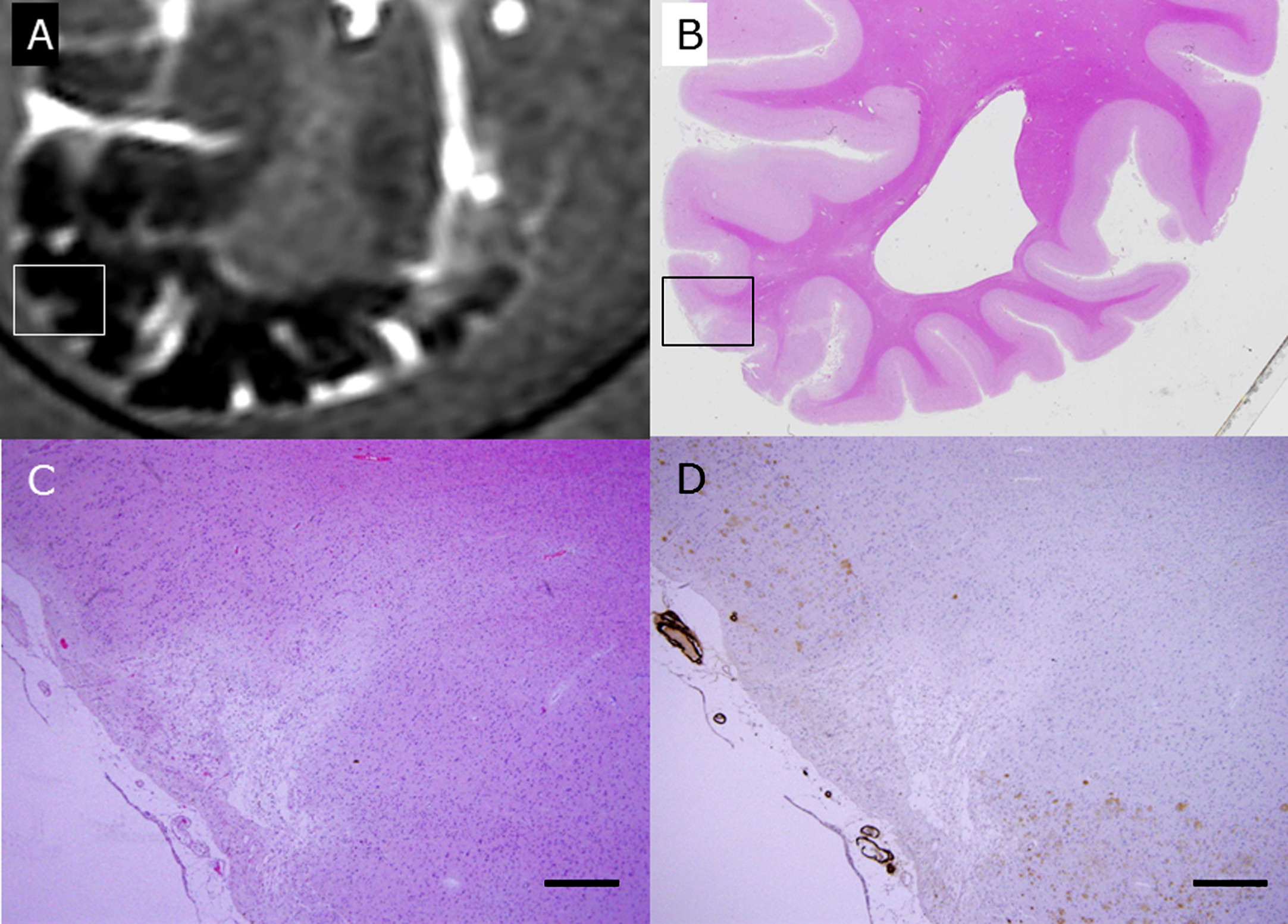 The rectangle in A is a wedge-shaped CMI detected by postmortem 3T MRI FLAIR imaging in the brain of subject C1 (A). This block was subsequently fixed, sliced, and stained with HE (B, C). The rectangle in B is enlarged in C and D. With immunohistochemistry for Aβ (D), senile plaques (brown) are lost in the surrounding CMI, and degenerated Aβ-positive vessels are apposed to the CMI. Scale bars in C and D: 500 μm.