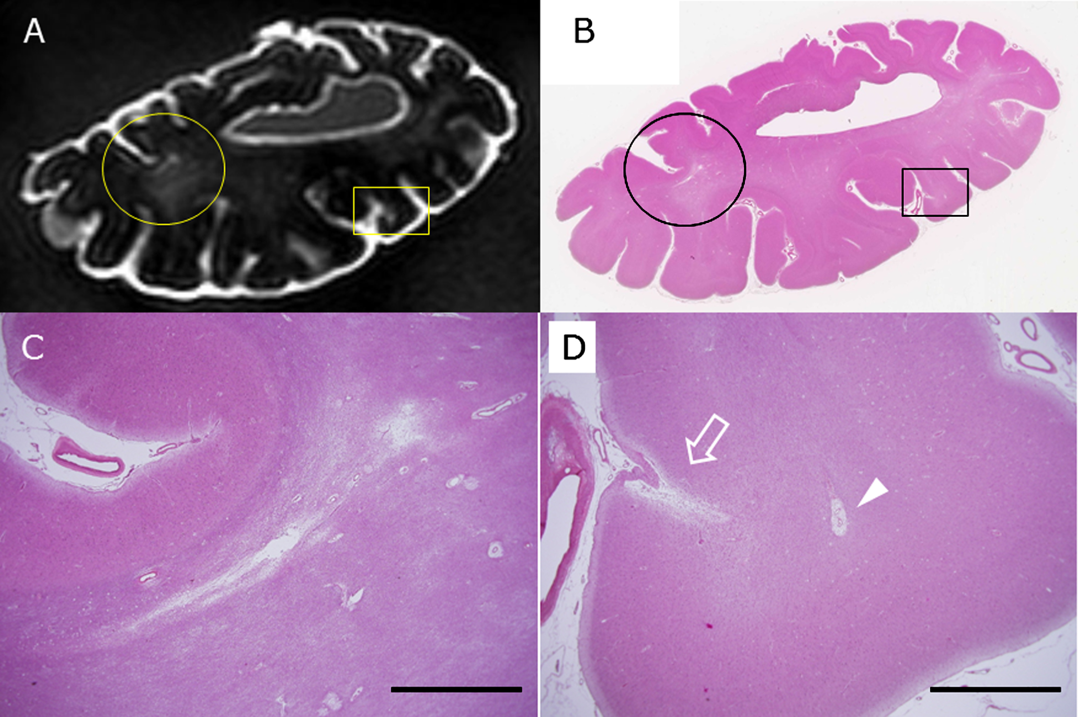 The circle and rectangle in A and B indicate a small subcortical infarction and a CMI, respectively. The circle is enlarged in C, and the rectangle is in D. The arrow indicates a CMI, and the arrowhead shows enlarged perivascular space (D) in the brain of subject C2 as detected by postmortem 3T MRI (A) and by HE staining of a section from the same block (B-D). Scale bars in C and D: 2 mm.
