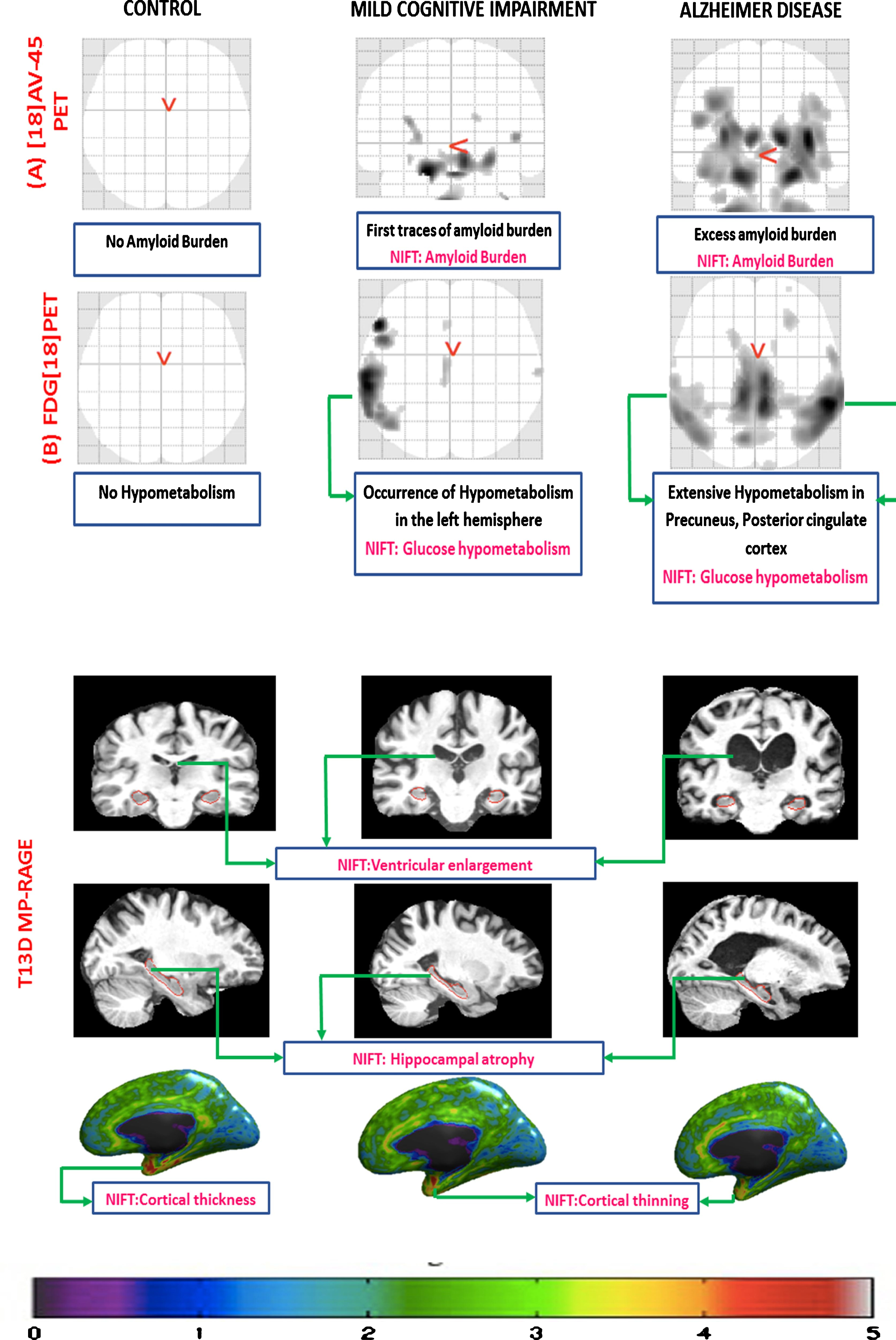 Manual annotation of brain image scans using NIFT. This figure represents different biomarkers captured using three different imaging techniques in control, mild cognitive impairment (MCI), and AD respectively. A) [18] AV-45 PET scan: this figure captures the increased amount of amyloid burden (p-value threshold 0.001; voxel extend 10; smoothing kernel [8-8-8]) during the disease progression across CN, MCI, and AD, respectively. B) FDG [18] PET: this figure captures no hypometabolism in control, increased hypometabolic pattern in case of MCI, and extensive hypometabolic topography in the temporo-parietal regions, precuneus, and posterior cingulate cortex (p-value threshold 0.001; voxel extend 10; smoothing kernel [8-8-8]). C) T13D MP-RAGE: the first row of the figure demonstrates the progressive ventricular enlargement among control, MCI, and AD respectively. The second row represents progressive hippocampal atrophy across control, MCI, and AD. The third row represents progressive cortical shrinkage in the temporal-parietal lobe, posterior cingulate and precuneus area.