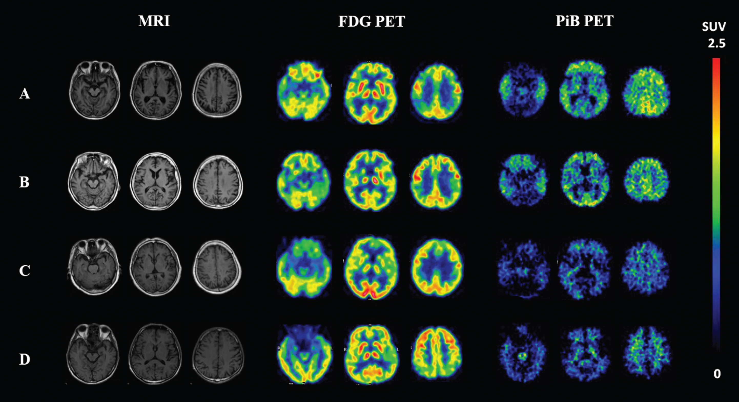 T1-weighted MRI, FDG-PET and PiB-PET images of four representative participants. A 64-year-old female AD patient with positive Aβ deposition on PiB-PET and “AD” type of hypometabolism on FDG-PET (A); a 76-year-old female MCI subject with positive Aβ deposition on PiB-PET and “AD” type of hypometabolism on FDG-PET (B); a 78-year-old female AD patient with negative PiB and “FTD” type of hypometabolism (C); and a 71-year-old male AD patient with negative PiB and non-specific hypometabolism on FDG-PET (D). FDG, fluorodeoxyglucose; PiB, Pittsburgh compound B; PET, positron emission tomography; AD, Alzheimer’s disease; MCI, mild cognitive impairment; FTD, frontotemporal dementia.