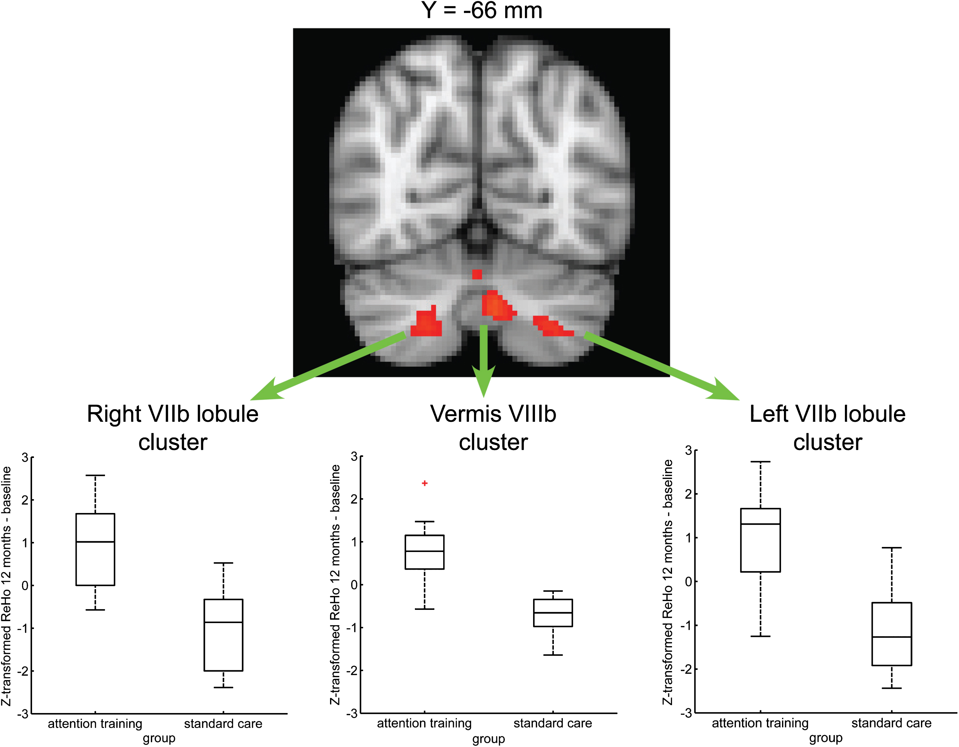 Improvement in long-term brain activity measured by ReHo of rsfMRI data. Between-group voxel-wise map (TFCE) showing significant (p < 0.05, corrected) evidence for a greater Z-transformed ReHo difference (12 months – baseline) in cerebellar areas (vermis VIIIb and bilateral VIIb lobule) involved in cognitive processes in the attention training group as compared to standard care group. The map is overlaid on the MNI152 template. In each cluster, the mean of the difference of the Z-transformed ReHo was positive for the attention training group (ReHo increased over time) and negative for the standard care group (ReHo decreased over time).