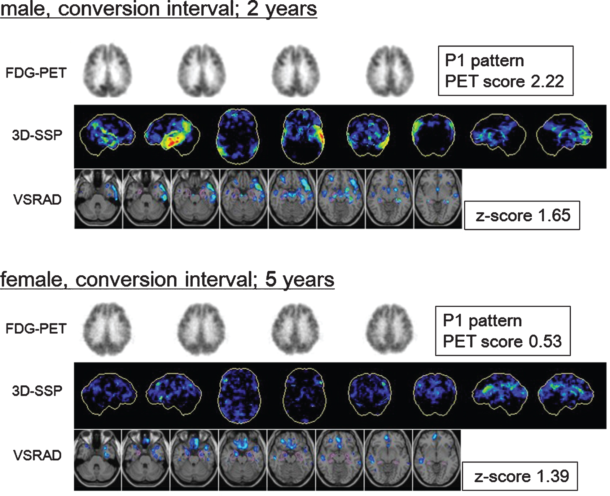 Fluorine-18-fluorodeoxyglucose positron emission tomography (18F-FDG-PET) transaxial images, 3-dimensional stereotactic surface projections (3D-SSP), and voxel-based specific regional analysis system for Alzheimer’s disease (VSRAD) images of patients with mild cognitive impairment (MCI) converted to Alzheimer’s disease (AD). Top: Baseline images of a male patient with MCI who converted during the second year. The 3D-SSP images show hypometabolism in the parietotemporal association cortex, posterior cingulate, and precuneus, mainly on the left side (visual assessment; P1 pattern, PET score = 2.22). The VSRAD images show atrophy in the bilateral temporal lobe including the volume of interest (VOI) placed on the medial temporal structures (VSRAD z-score = 1.65). Bottom: Baseline images of a patient with MCI who converted in the fifth year. The 3D-SSP images show slight hypometabolism in the parietotemporal association cortex, posterior cingulate, and precuneus (visual assessment; P1 pattern, PET score = 0.53). The VSRAD images show mild atrophy in the target VOI (VSRAD z-score = 1.39). The earlier converter exhibited clearer AD-like changes at baseline than slower converter did.
