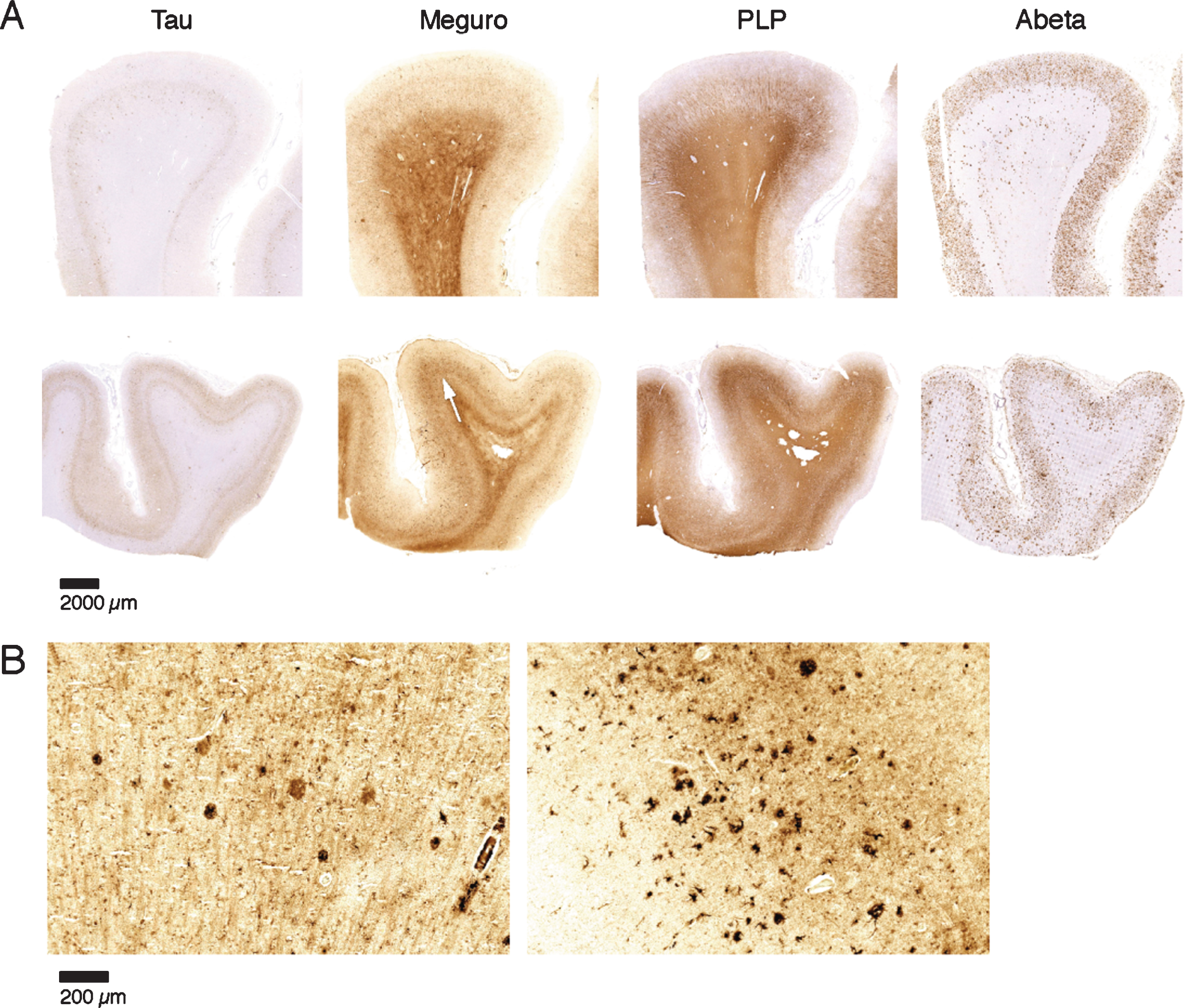 Iron accumulation in AD, related to tau pathology and Aβ plaques. A) Both patients (first and second row) show similar amounts of Aβ plaques but only the tissue with the most severe tau pathology shows a diffuse band shaped increase of iron/PLP labelling in the middle cortical layers (arrows). B) 20 μm sections of the same blocks. Cortex with the most severe tau pathology shows more iron accumulation in plaques and microglia.