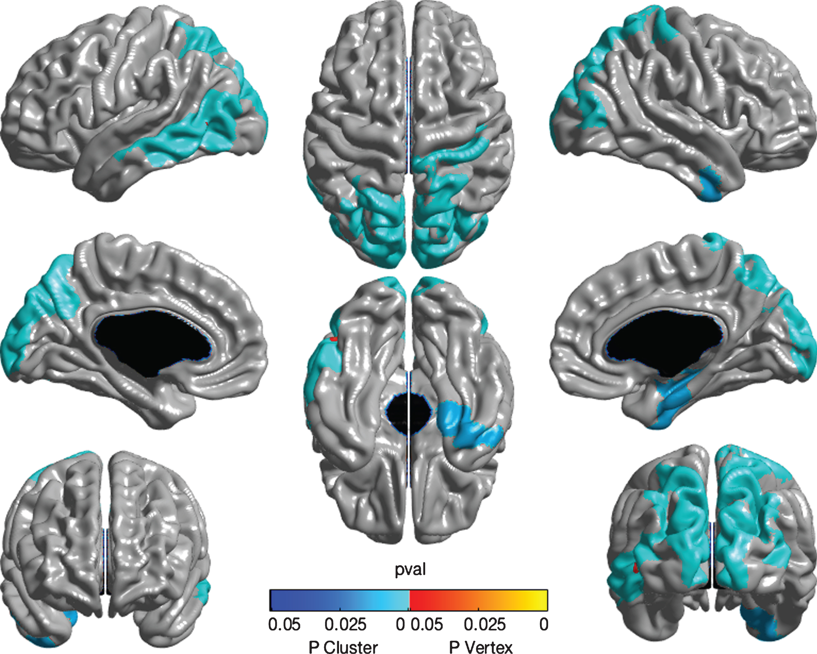 Whole brain cortical thickness measures associated with SSI-ICM. The figure displays a color map representing results of whole brain random-field theory cortical thickness analysis. The images, in sequence from top left, show left-lateral, dorsal, right-lateral, left-mesial, ventral, and right-mesial views, while the lower images show coronal views from rostral (left) and caudal (right) perspectives. Analyses adjusted for age, gender, education, APOE ɛ4 status, and tone test. The adjusted SSI-ICM score displayed a positive relationship with right Heschl’s gyrus at the peak level (indicated by red colored point). SSI-ICM score showed a positive relationship with thickness of the left and right precuneus, with extension to adjacent inferior parietal and occipital cortices. Also of interest are positive associations with right parahippocampal and entorhinal cortices, as well as left inferior and mid temporal gyri. All these areas are displayed as blue colored areas and are statistically significant as clusters.