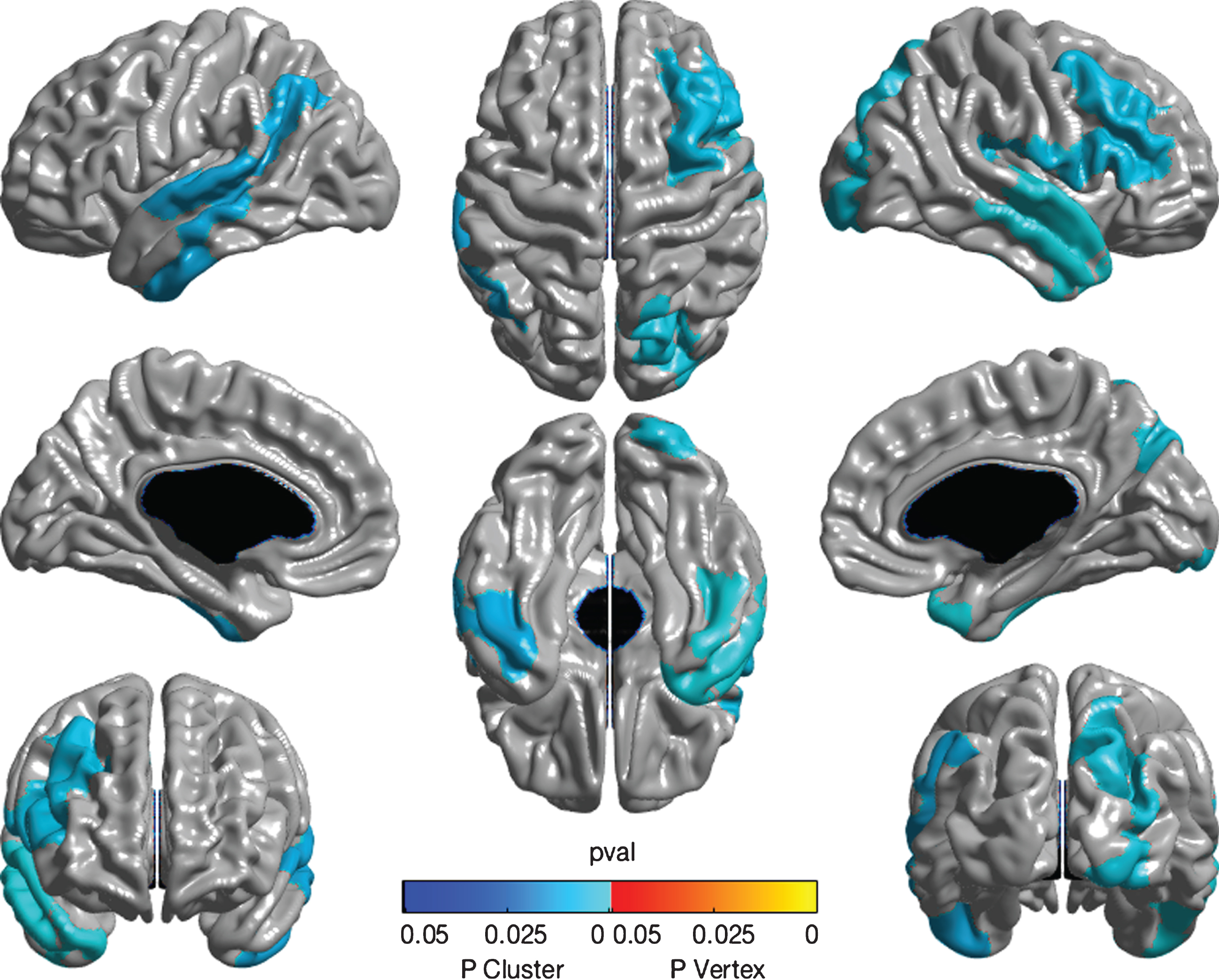 Whole brain cortical thickness measures associated with DSI-REA. Color map showing association of DSI-REA score with cortical thickness estimated using whole brain random-field theory analysis. The different image perspectives are as explained in Fig. 1. After adjustment for age, gender, education, APOE ɛ4 status, and tone test, DSI-REA score (representing presumed degeneration of transcortical auditory pathways) showed an inverse relationship with thickness of the right dorsomedial and inferior frontal cortices, as indicated in pale blue. Also shown are associations with thickness of left superior and transverse temporal cortices as well as bilateral inferior temporal gyri, right anterior temporal pole, and right precuneus. Analyses are significant at the cluster level, as shown. No significant peaks are observed.