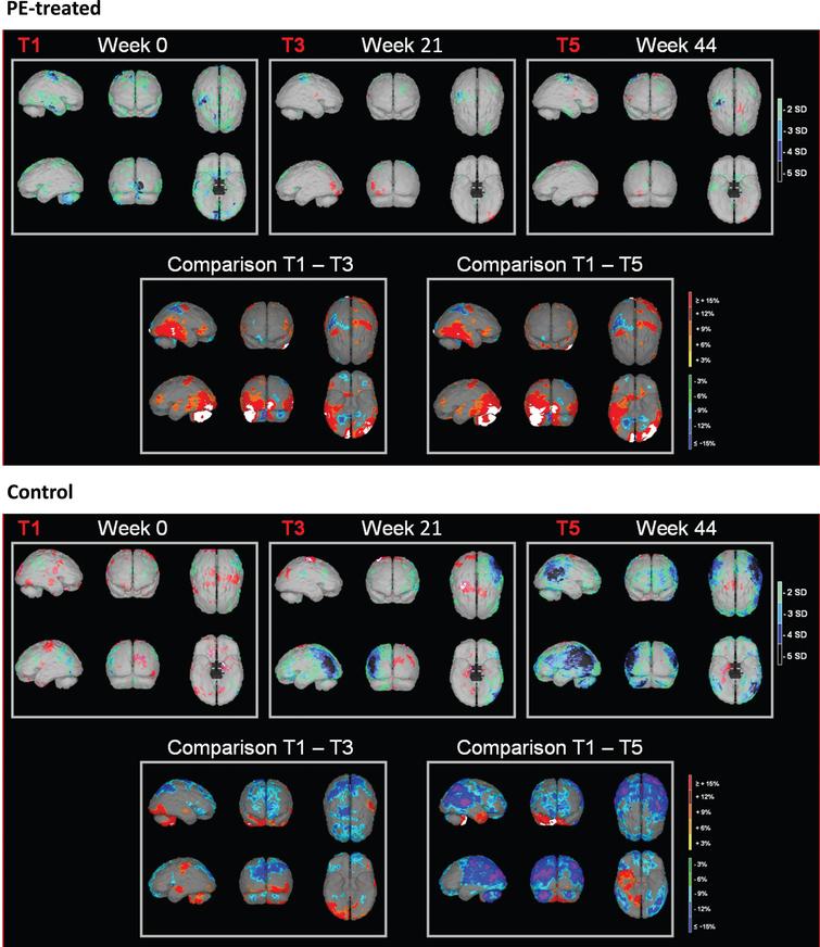 Representative images of NeuroGam® analysis of brain perfusion in a plasma exchange [PE]-treated patient (upper panel) and an untreated control patient (lower panel). Color scale in images at week 0 (baseline, T1), 21 (end of treatment, T3), and 44 (end of follow-up, T5) indicates Z-score (number of standard deviations [SD] with respect to mean). Color scale in the images of T1–T3 and T1–T5 comparisons indicates the difference (increase or decrease) in percentage.