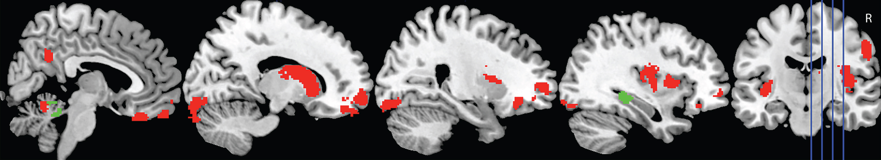 Voxel-based morphometry covariate analyses showing brain regions which correlate significantly with task performance in AD (green) and bvFTD (red). Colored voxels show regions that were significant in the analyses at p < 0.001 uncorrected. All clusters reported t > 3.3. Education is included as a covariate in all analyses. R, right. For full description of clusters and relevant coordinates, please refer to Table 3.