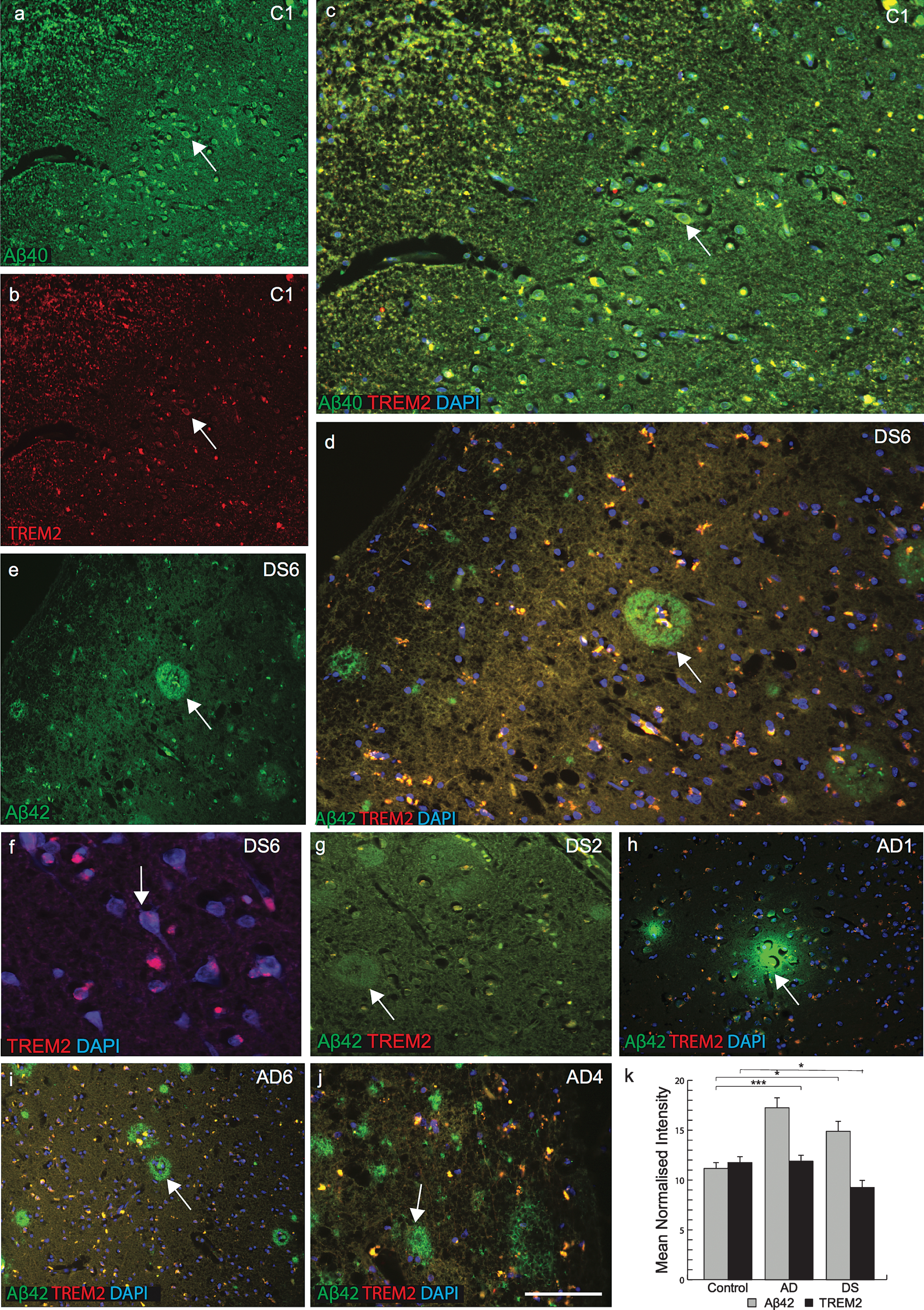 TREM2 protein is absent in senile plaques in DS brain. Double immunofluorescence staining was performed in the temporal cortex of normal control brain tissue by using the rabbit polyclonal anti-Aβ40 (green), mouse monoclonal anti-TREM2 (red), and DAPI for nuclei (Blue). Aβ40 immunoreactivity was visible in pyramidal neurons (a), TREM2 in the cell body (b), and both proteins co-localized in the perinuclear location in pyramidal neurons (c). In DS (DS6), layer III temporal cortex sections stained for Aβ42 (green) and TREM2 (red) showed many mature plaques (d & e). TREM2 was rarely present in the core of the plaques (d) and in neurons (f). Further staining on a different case (DS2) showed that Aβ42 did not co-localize with TREM2 (g). In AD brain, TREM2 protein was visible around the plaques (h-j). Aβ42 level was highest in AD brain (k, p < 0.0001) and TREM2 level was lower in surviving neurons compared to control and AD brain (K, p < 0.01). The scale bar in a-e = 50μm, f = 25μm, and g = 40μm. These data represent the mean±S.E from three independent experiments. Error bars indicate SEM. *p < 0.01, **p < 0.001, ***p < 0.0001.