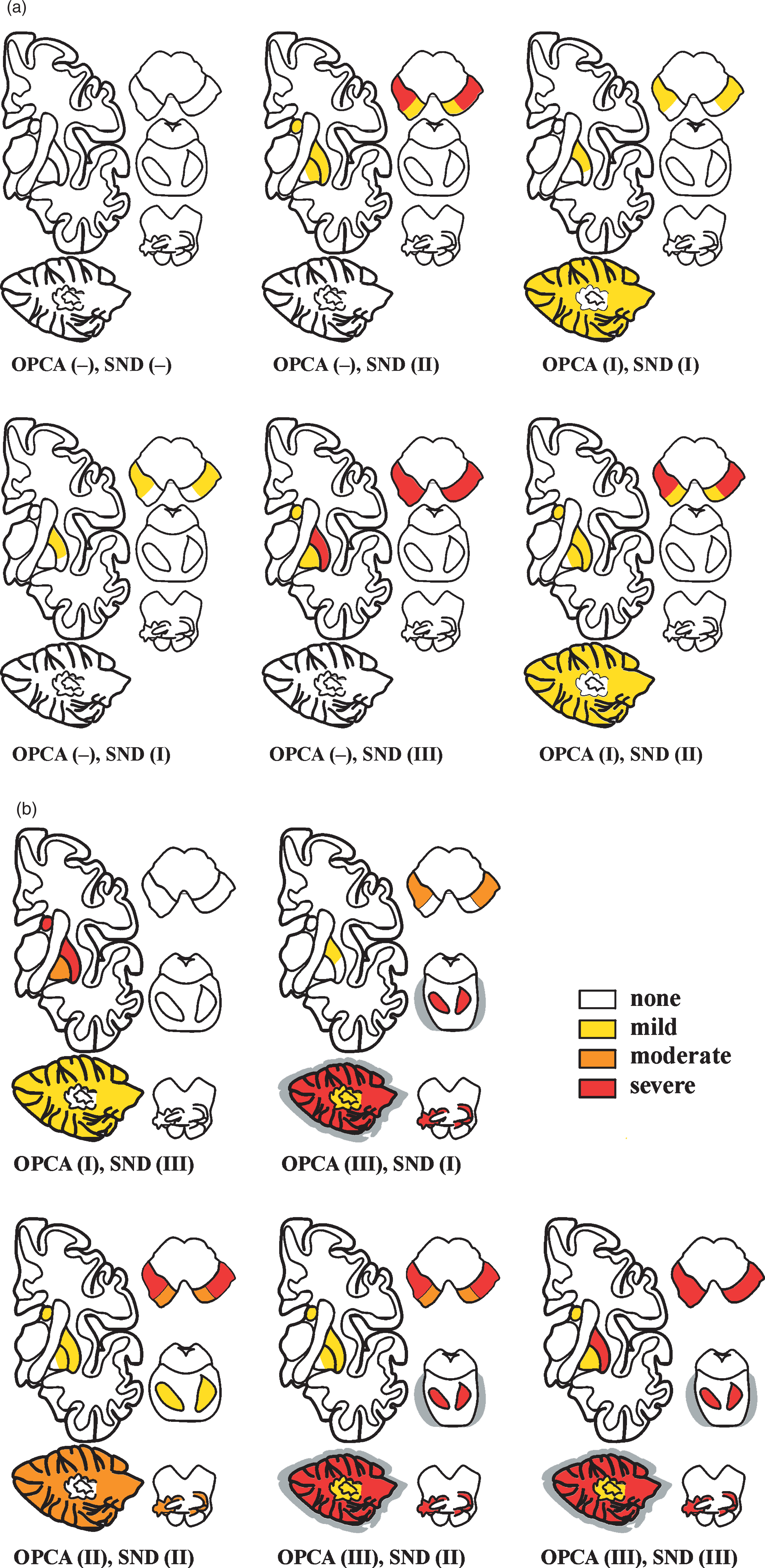 Schematic distribution of various combination types of SND and OPCA in 42 autopsy-proven cases of MSA (22 MS-P, 20 MS-C), showing different severity of morphological lesions (from [213]).