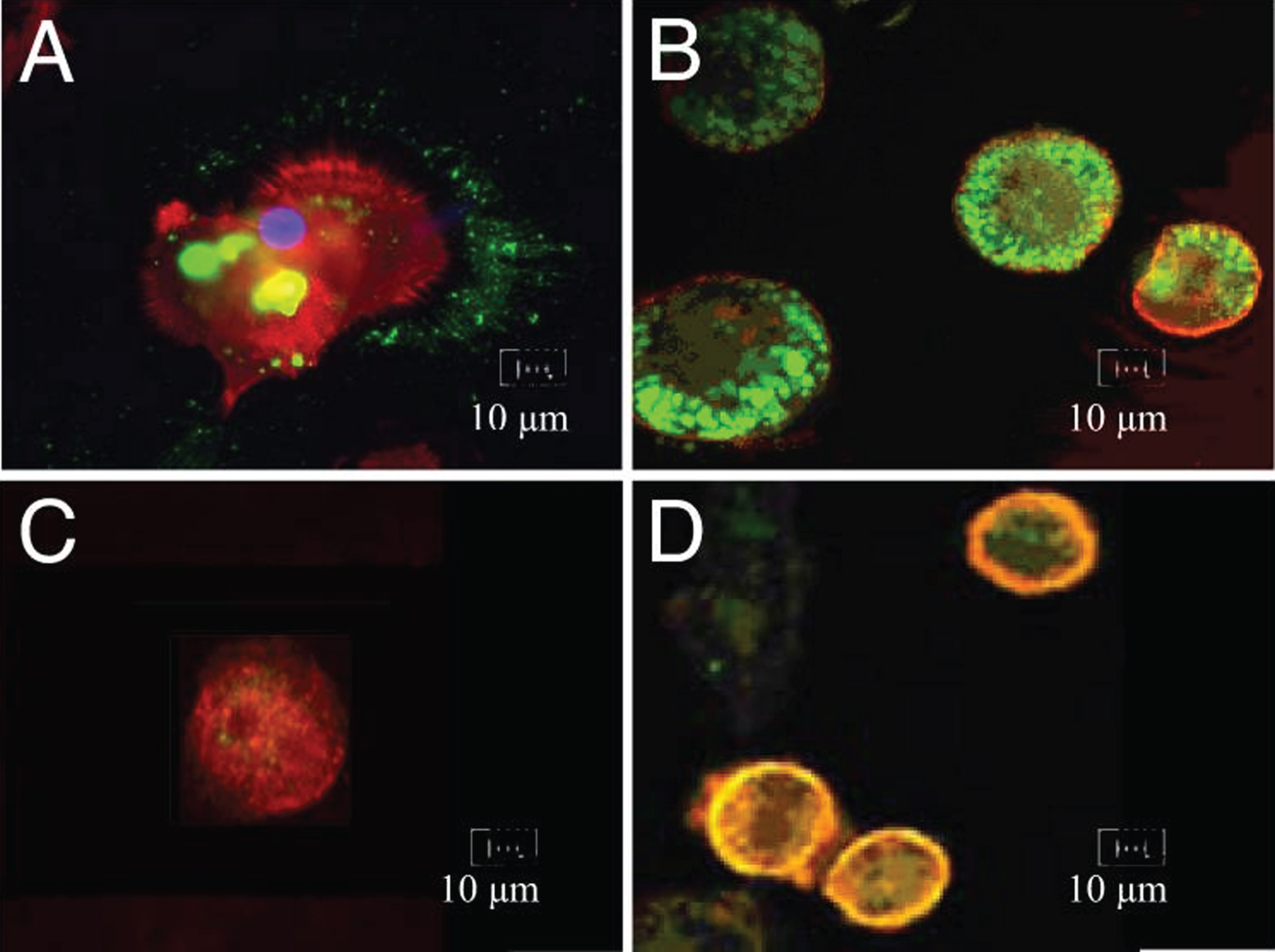 Vigorous phagocytosis of FITC-Aβ (green) by control macrophages (red) (A,B) but no phagocytosis or only surface binding without phagocytosis by AD macrophages (C,D) (from Fiala et al. [2]).