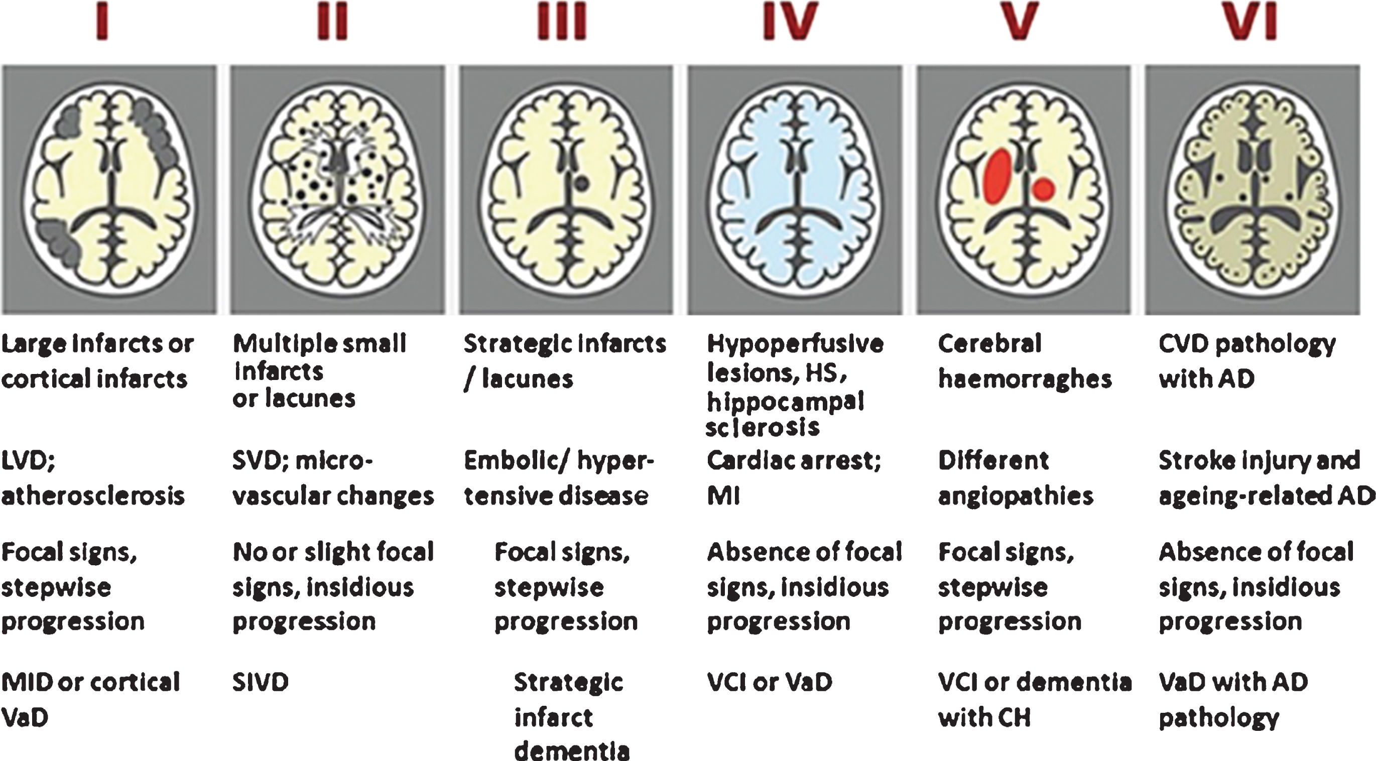 Newcastle categorization in six subtypes of different cerebrovascular pathologies associated with VCI. Post-stroke survivors are included in subtypes I–III. Cases with extensive WM disease in the absence of significant other features are included under SVD. Subtype I may result from large vessel occlusion (athero-thromboembolism), artery-to-artery embolism or cardioembolism. Subtype II usually involves arteriosclerosis, lipohyalinosis and hypertensive, arteriosclerotic, amyloid or collagen angiopathy. Subtypes I, II and V may result from aneurysms, arterial dissections, arteriovenous malformations and various forms of arteritis (vasculitis). AD, Alzheimer’s disease; CH, cerebral haemorrhage; CVD, cerebrovascular disease; MI, myocardial infarction; MID, multi-infarct dementia; LVD, large vessel disease; SIVD, subcortical ischemic vascular dementia; SVD, small vessel disease; VCI, vascular cognitive impairment; VaD, vascular dementia. From: Kalaria RN, 2016 [13].