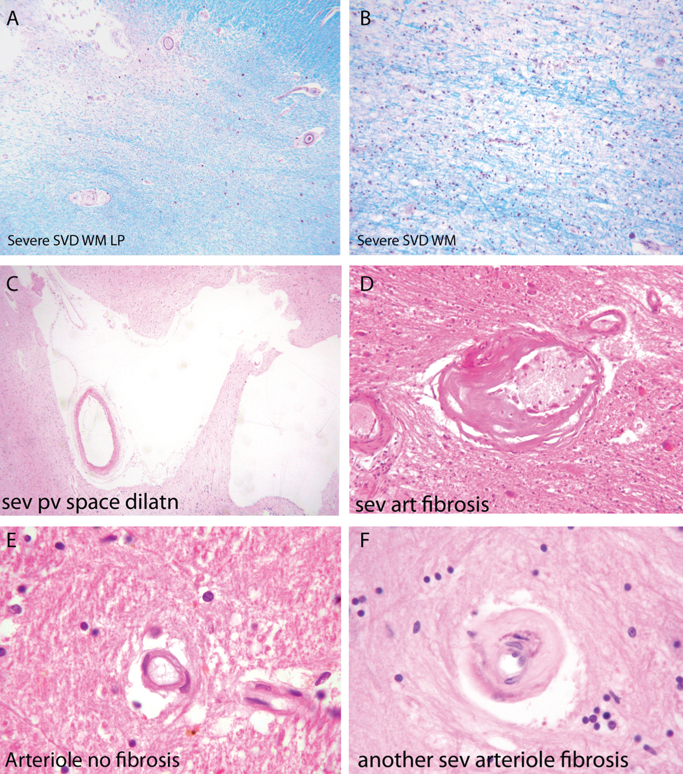 Components of the pathology due to SSVD. A, B) Low power (A) and higher power (B) views of a histological section from a case of SSVD. The section has been stained for myelin (blue) (Luxol fast blue/cresyl violet stain). There is diffuse pallor of staining and, at the top left corner of the section in (A), the tissue is necrotic. B) Damaged white matter at higher power. The nuclei (purple) are chiefly those of infiltrating macrophages. C) Greatly dilated perivascular space (hematoxylin and eosin stain). D) Small artery with a grossly thickened wall in which collagen has replaced smooth muscle (hematoxylin and eosin stain). E) Normal white matter arterioles in which the deeper pink cells are smooth muscle cells. F) Severely fibrotic and stenosed arteriole from a case of SSVD (E and F, hematoxylin and eosin).