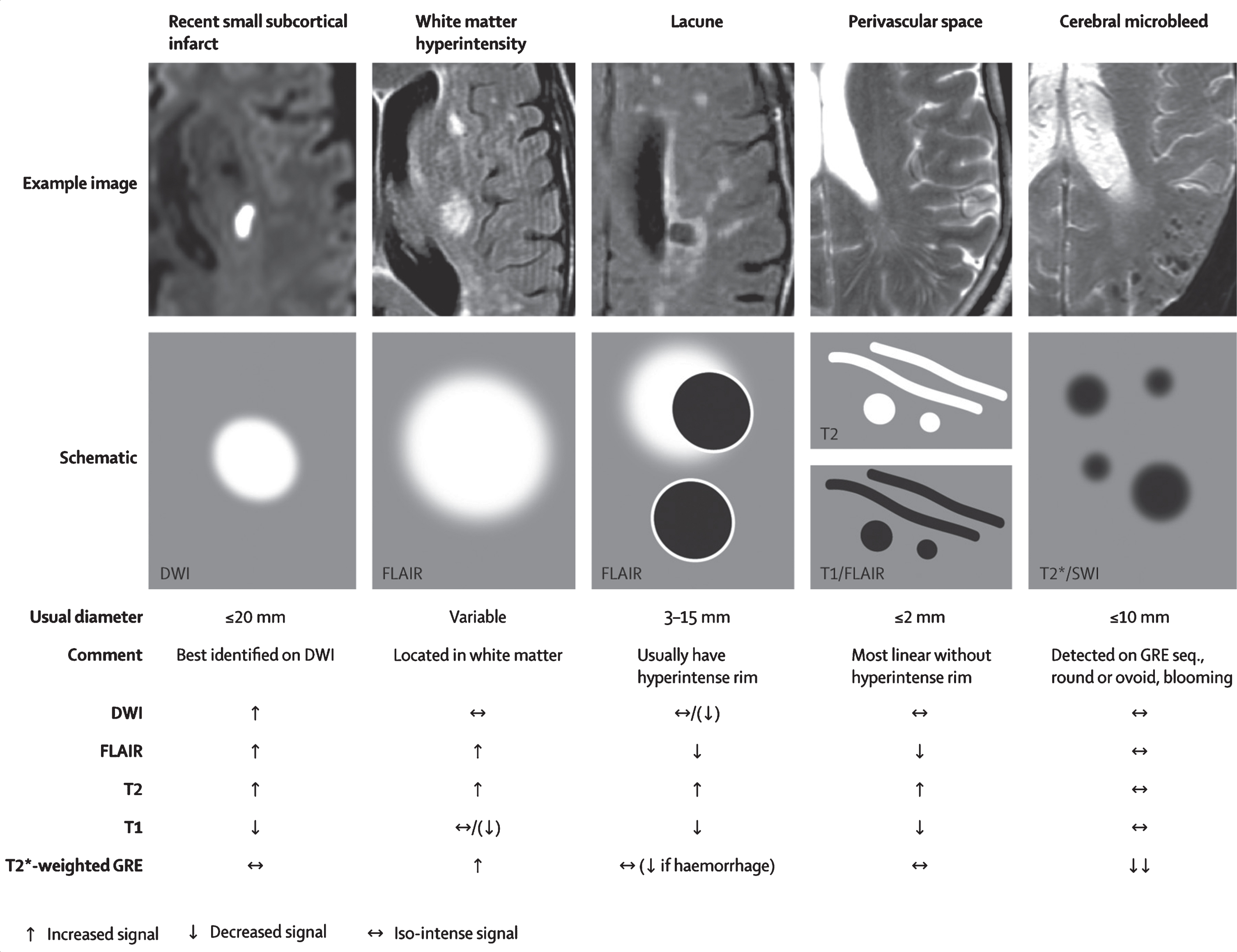 Examples of different features of small vessel disease, including white matter hyperintensities, as published by the STandards for ReportIng Vascular changes on nEuroimaging (STRIVE) study group. From: Wardlaw et al., 2013 [145].