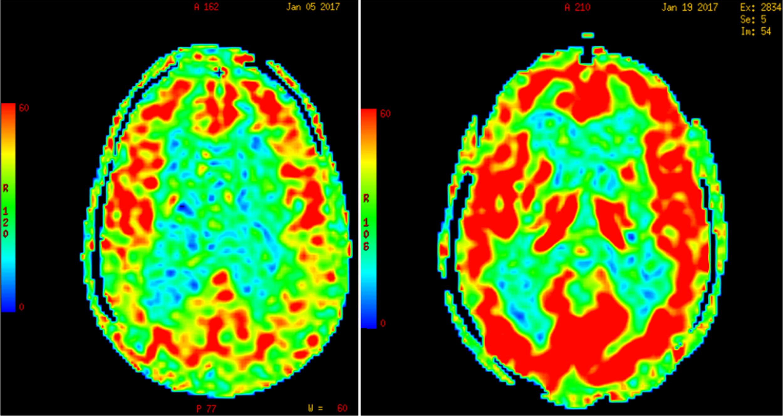 Increase in global cerebral blood flow determined by arterial spin label MR imaging post-lumbar puncture in a patient with normal-pressure hydrocephalus. (Román GC and Fung S, unpublished data).