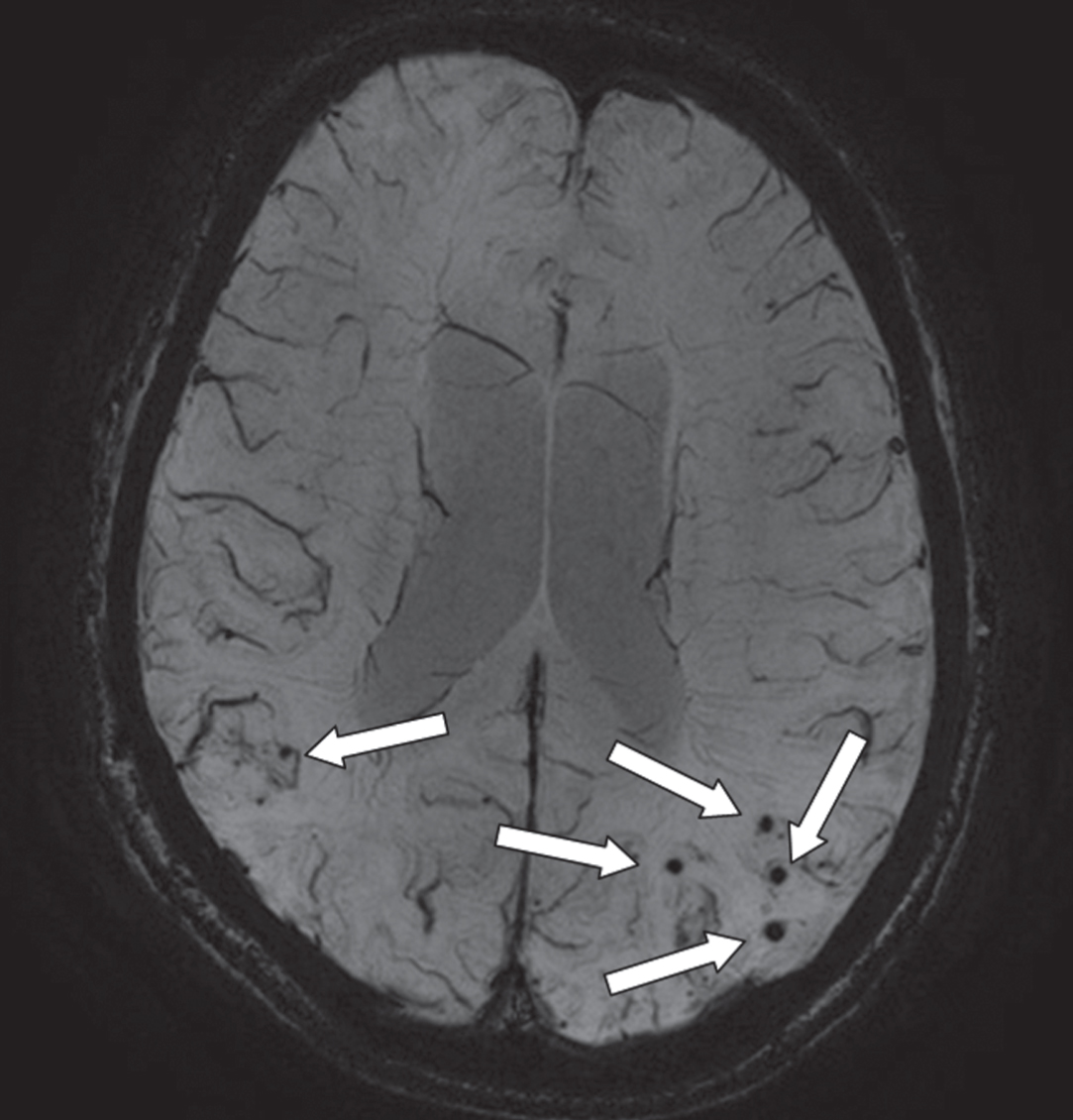An axial MRI image of a susceptibility weighted image (SWI) that provides information on the presence of microbleeds (arrows; occipital part of the cortex). This is an image of a 68-year-old male with a diagnosis of Alzheimer’s disease. On presentation, he had an MMSE of 23. On MRI, there was evidence of moderate atrophy of the medial temporal lobe, mild global cortical atrophy, beginning confluent white matter hyperintensities and multiple microbleeds (mostly with a lobar location).