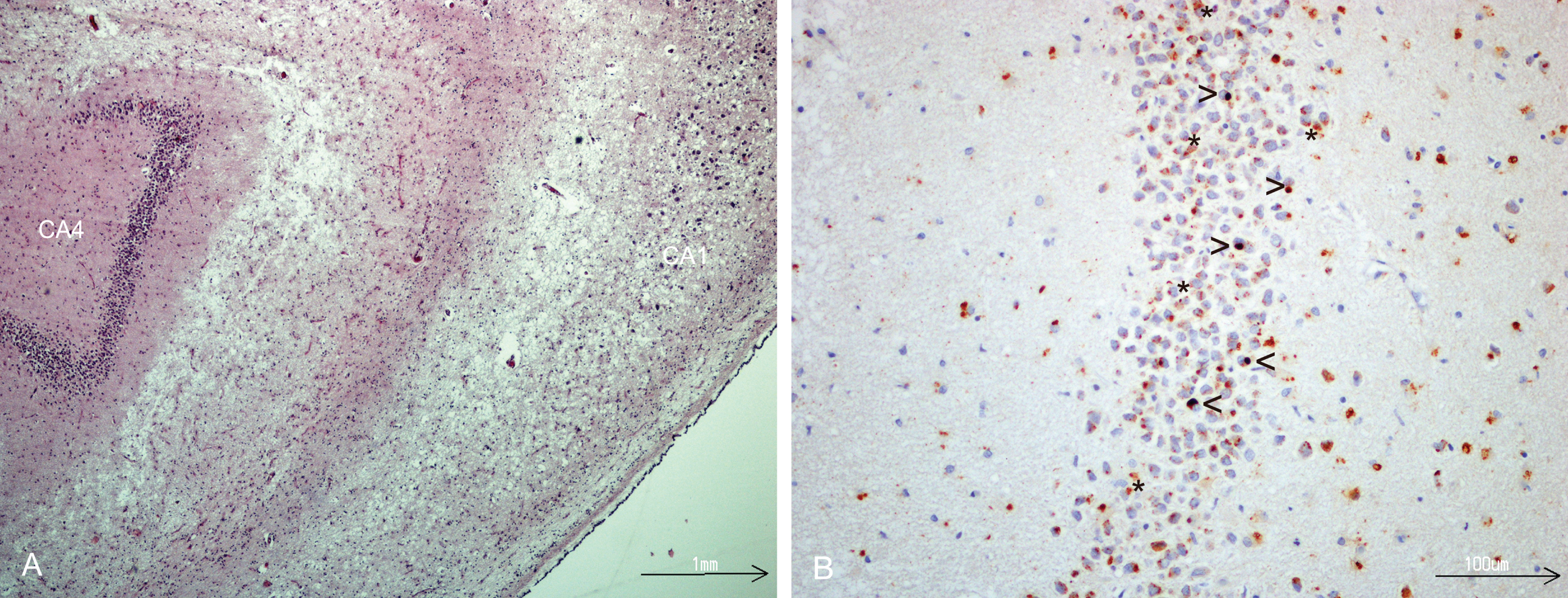 A) Hippocampal sclerosis, severe neuronal loss in CA1 sector, HE- stained. B) TDP-43 immunostaining of dentate fascia granule cells showing NCIs, (open arrow head), dark brown. Lipofuscin (star) is seen as yellowish granular deposits.