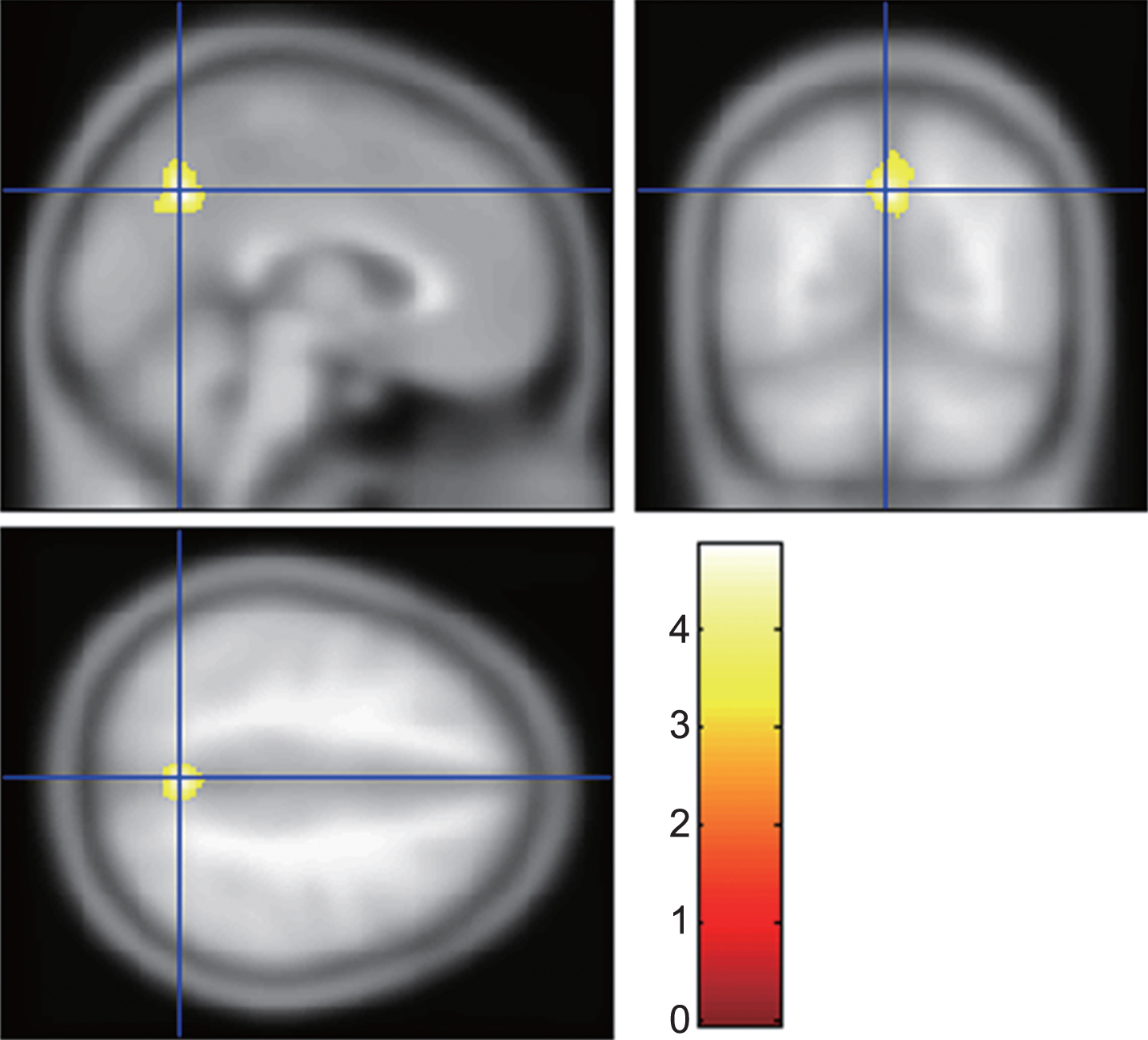 Brain region involved in sleep disturbance in Alzheimer’s disease (AD). The gray matter volume of the precuneus in AD with sleep disturbance was significantly smaller than that in AD without sleep disturbance. The statistical thresholds were set to uncorrected p-values of 0.001 at the voxel level and to corrected p-values of 0.05 at the cluster level.