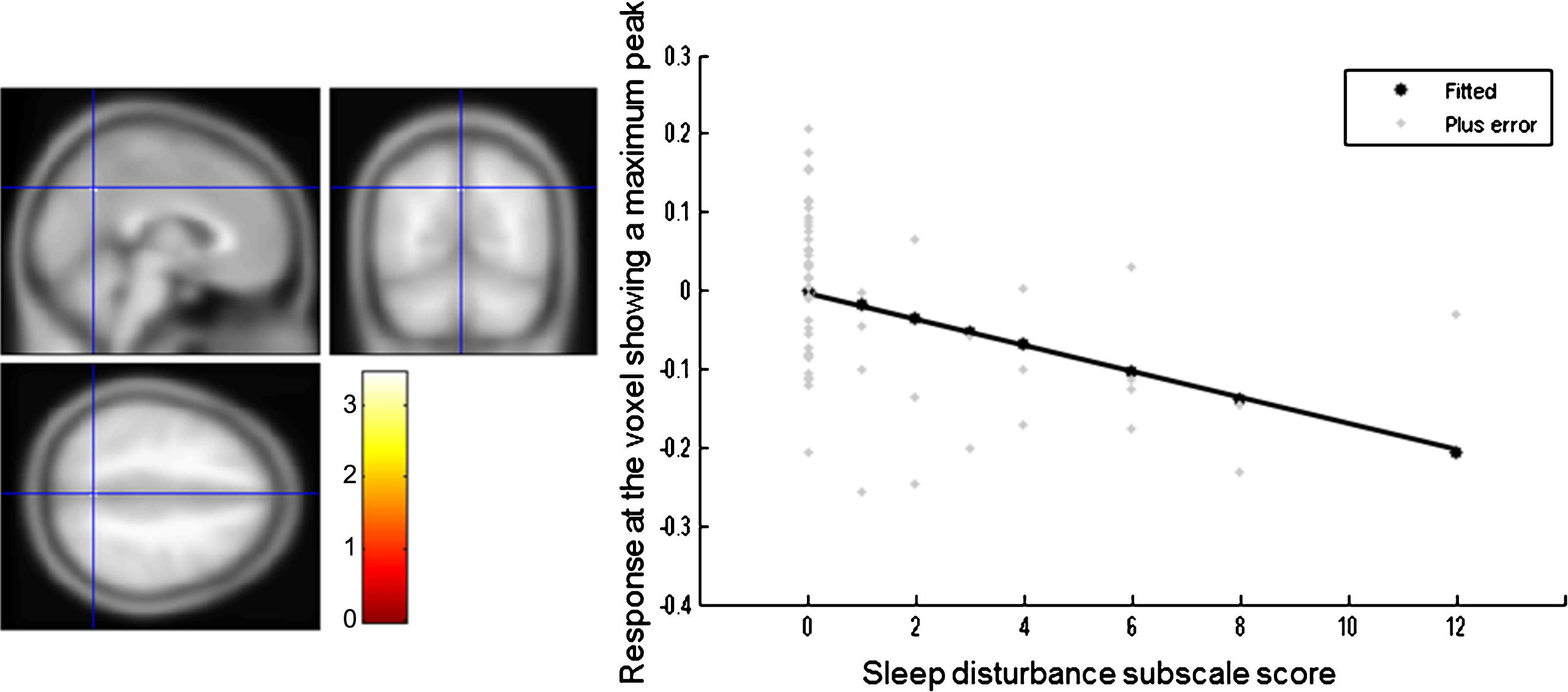 Brain region correlated with sleep disturbance subscale score in all patients with Alzheimer’s disease. The statistical thresholds were set to uncorrected p-values of 0.001 at the voxel level.
