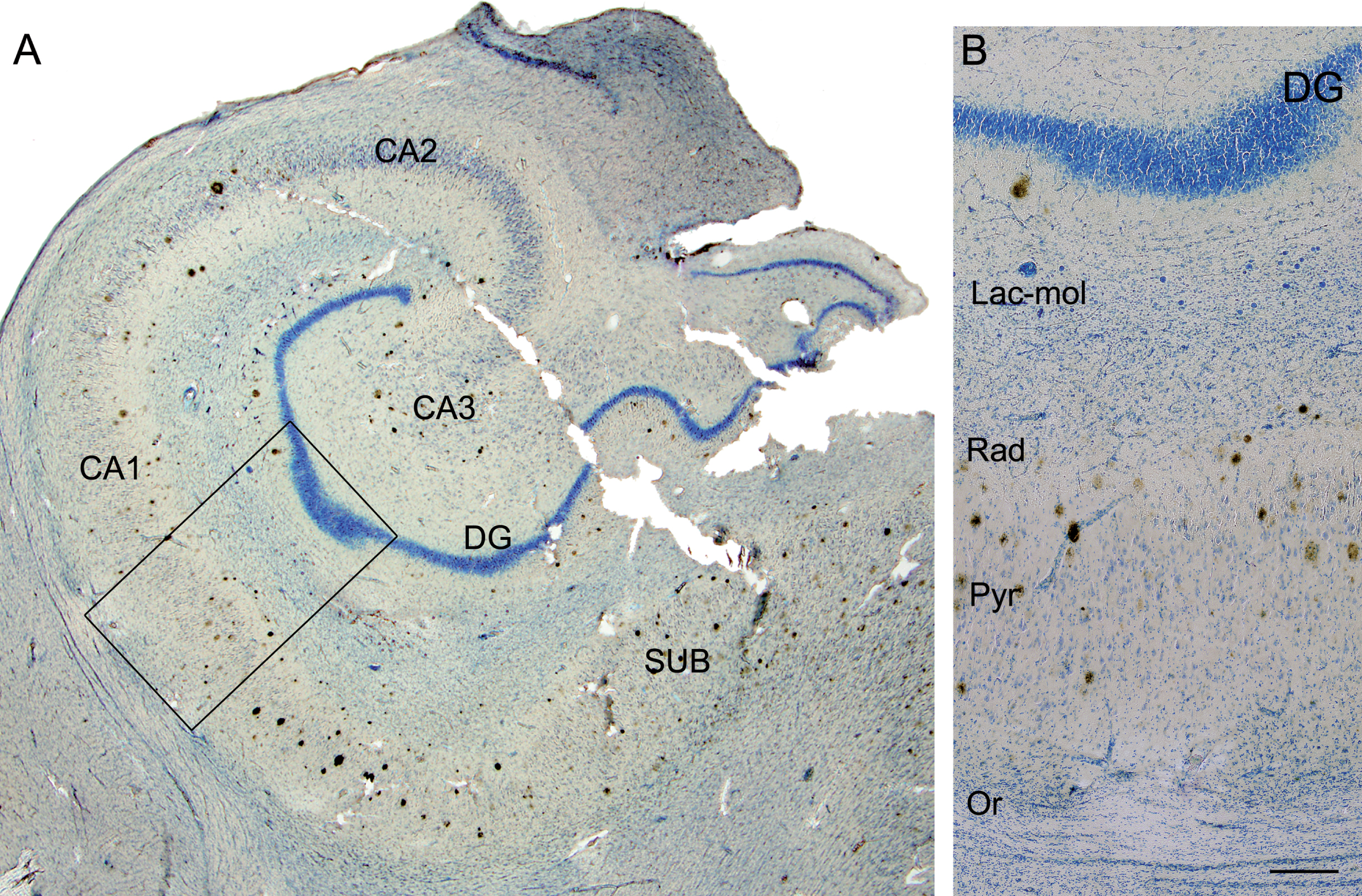 Photomicrograph of the hippocampal formation from an AD patient in a double-stained section (Nissl and anti-Aβ). A) Low-power microphotograph to illustrate the hippocampal fields. B) Higher magnification of the boxed area in A, showing the distribution of plaques by layer in CA1 (Lac-mol, stratum lacunosum-moleculare; Rad, stratum radiatum; Pyr, stratum pyramidale; Or, stratum oriens). Note that no plaques are visualized in stratum lacunosum-moleculare or in oriens. DG, dentate gyrus; CA1–CA3, cornus ammonis fields; SUB, subiculum. Scale bar: 1000μm (in B); 860μm (in A).
