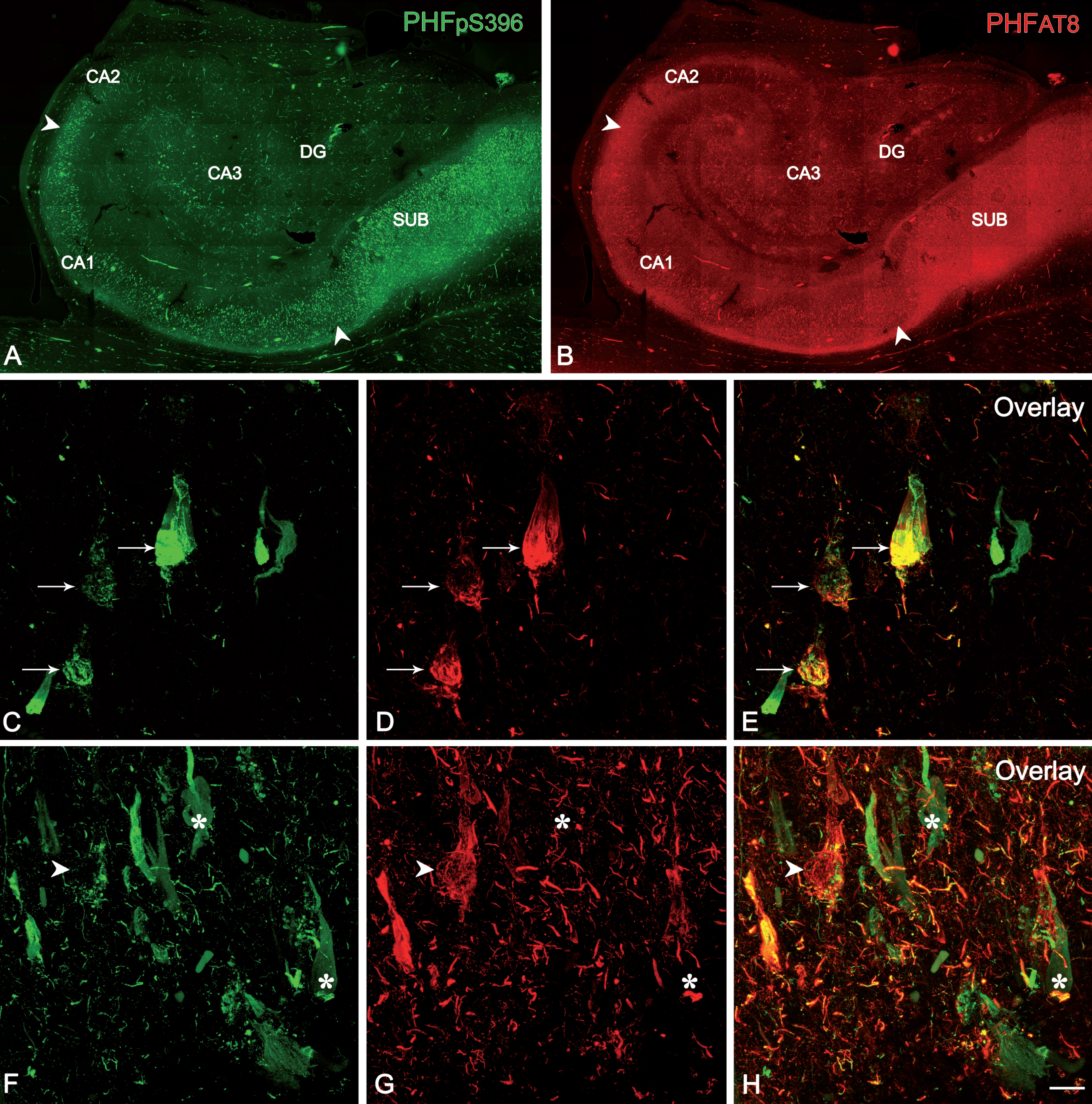 Confocal stack projection images to illustrate labeling patterns of neurons in double-immunostained sections for PHFpS396 and PHFAT8. Low-power confocal images of the hippocampal formation showing immunostaining for PHFpS396 (A, in green) and PHFAT8 (B, in red). Arrowheads indicate CA1 boundaries. C–H) Trios of confocal stack projection images taken from PHFpS396/PHFAT8 double-immunostained sections. Arrows designate neurons expressing both anti-PHFpS396 and anti-PHFAT8 (C–E). Arrowheads indicate a neuron expressing anti-PHFAT8, and asterisks indicate two neurons expressing only PHFpS396. DG, dentate gyrus; CA1–CA3, cornu ammonis fields; SUB, subiculum. Scale bar (in H): 922μm (in A, B) and 50μm (in C–H).