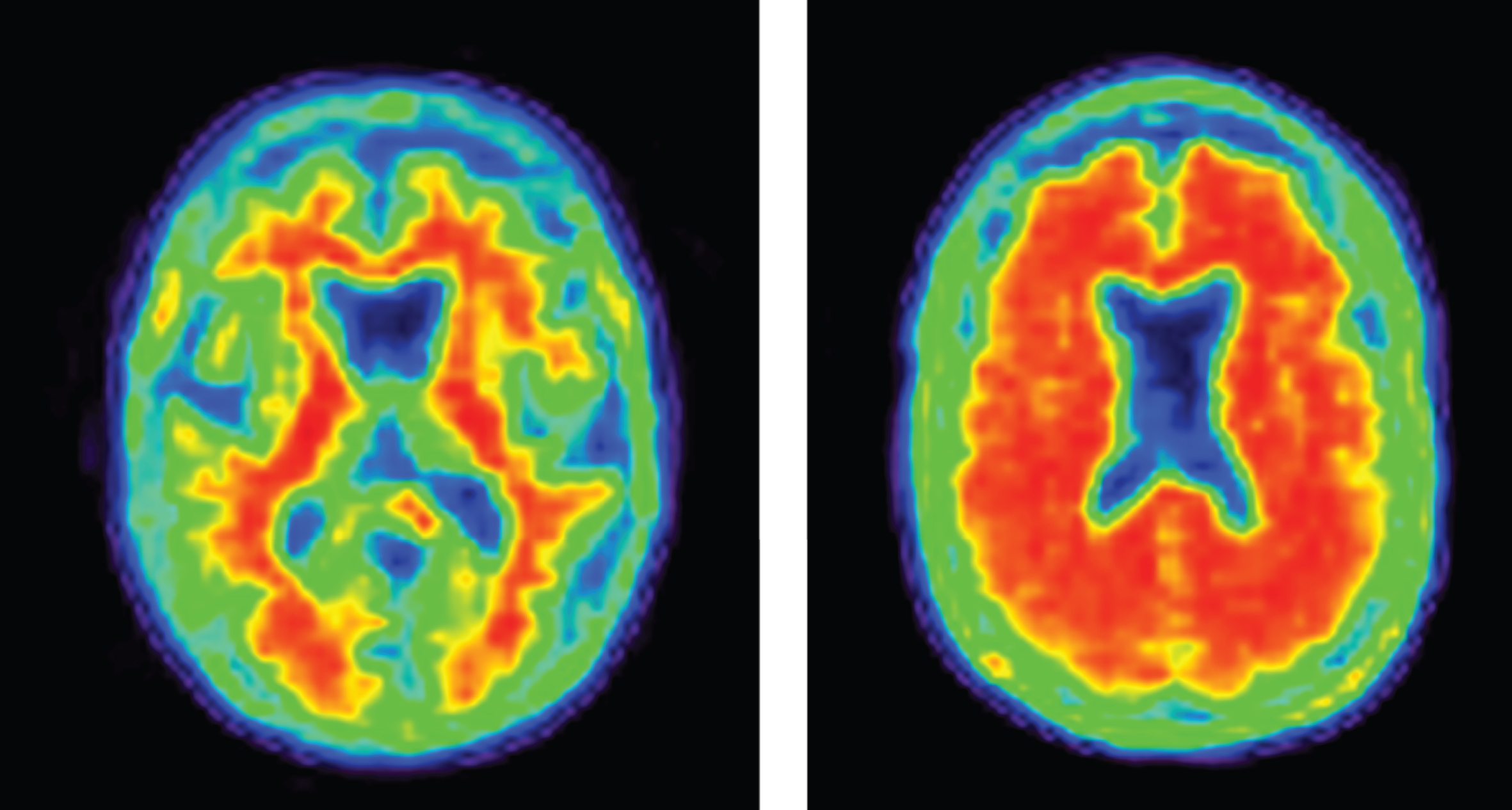 Negative (normal) and positive (abnormal; consistent with AD) amyloid PET images.