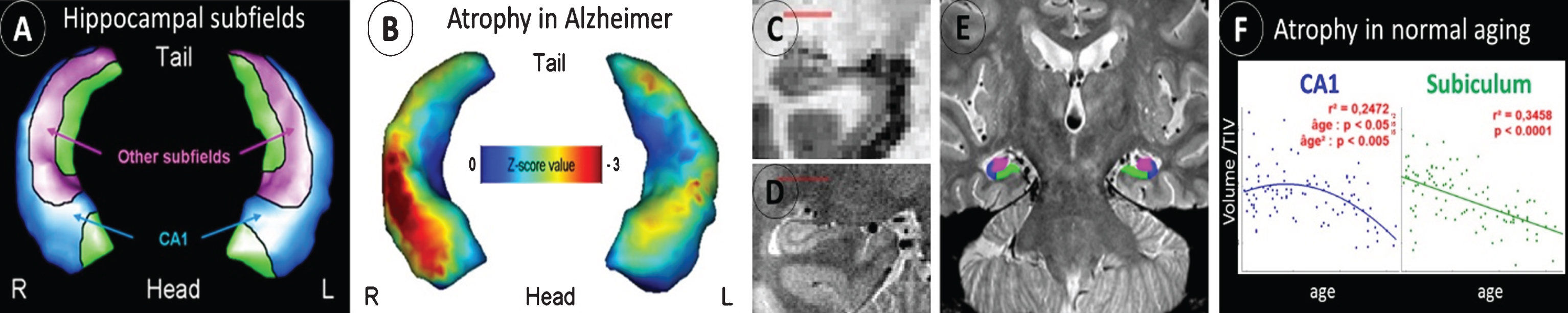 Differential alteration of hippocampal subfields in AD versus normal aging. The hippocampal subfields can be distinguished on 3D hippocampal surface views (A), and this technique showed predominant atrophy of the CA1 subfield in AD (B). Compared to standard resolution T1 MRI (C), a high-resolution proton density MRI sequence allows to visualize the hippocampus fine anatomy (D) and thus to delineate the different hippocampal subfields (E). This approach is promising for early AD diagnosis as it allows to distinguish the effects of AD from that of other conditions such as normal aging (F).