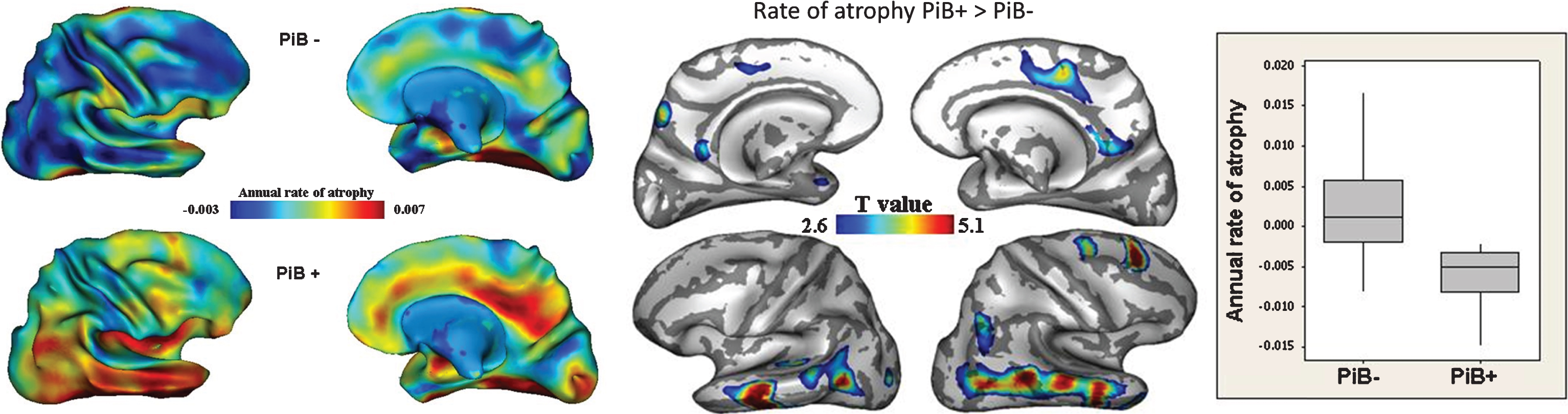 Comparison of the rate of atrophy over two years between cognitively intact older adults with (PIB+) and without (PIB-) Aβ deposition in their brain (as measured with PIB-PET) (Left). This study shows a greater rate of atrophy in PIB+ individuals, especially in the temporal neocortex and posterior and middle cingulate cortex (Right). From [35].