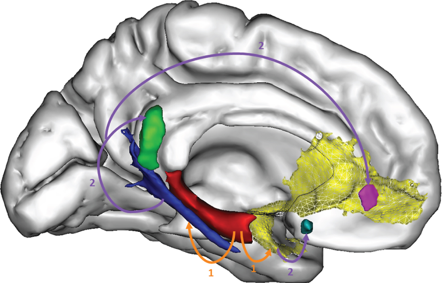 Distant relationships between atrophy and hypometabolism in AD. Using original methods especially developed for this purpose, we showed that hippocampal atrophy (red) was at least partly responsible for the disruption of white matter fibers (the perforant path in blue and the uncinate fasciculus in yellow) (1) itself responsible for hypometabolism in the posterior cingulate (green) and medial orbitofrontal cortex (purple and light blue) (2). From [42].