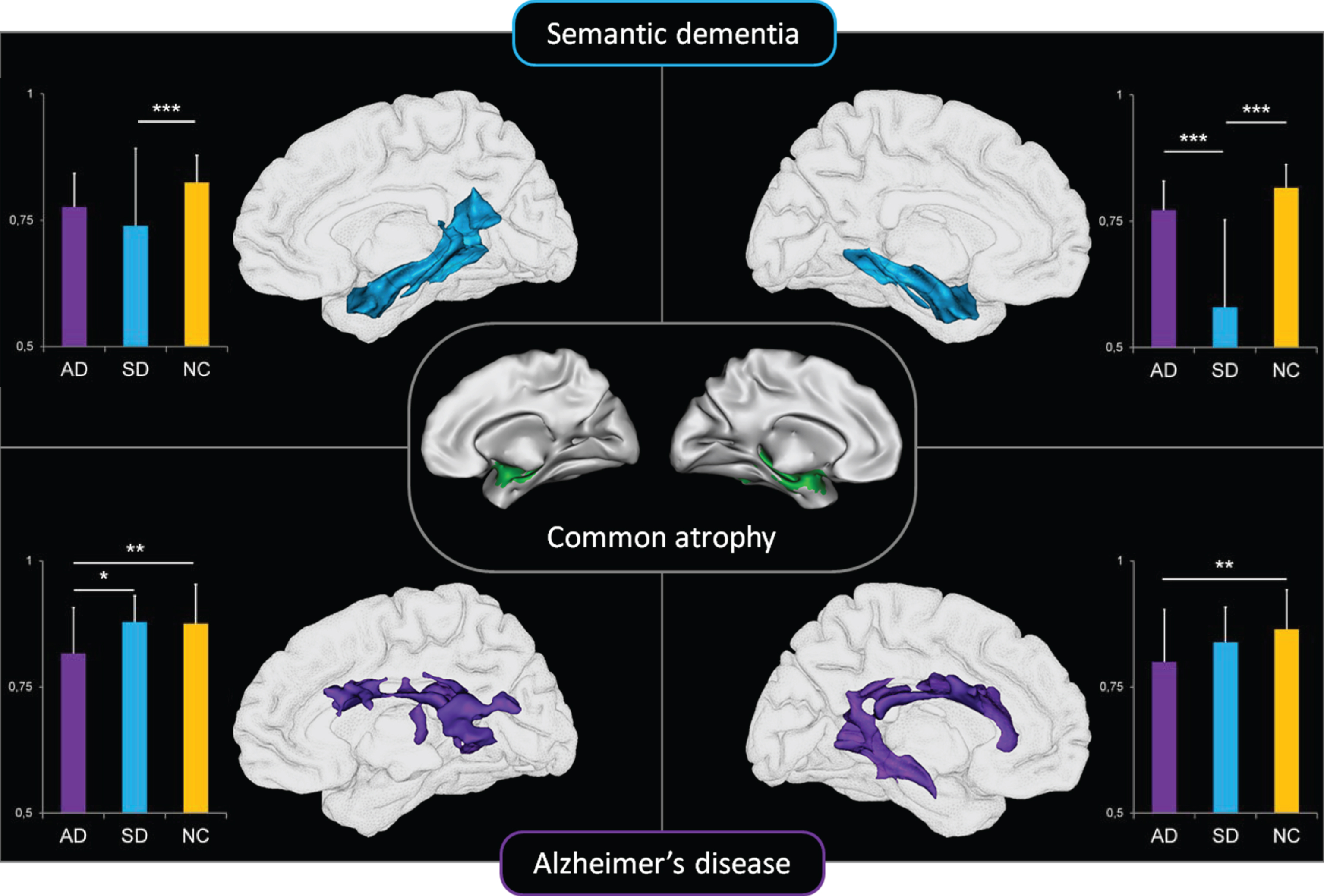 Relationships between medial temporal lobe atrophy common to AD and SD (center panel) and whole-brain white matter density maps in patients with AD (top panel) and semantic dementia (bottom panel). From [45].