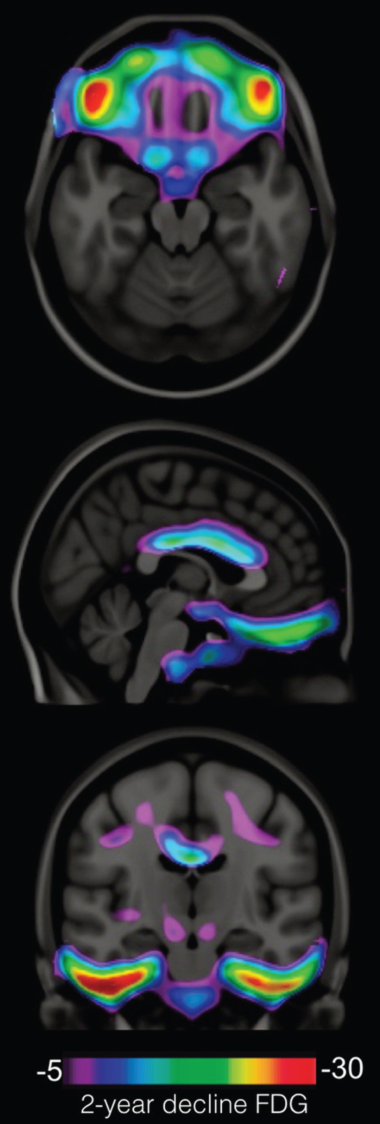 Brain regions vulnerable to the synergy between Aβ and tau in cognitively normal persons. The parametric map, overlaid in a structural MRI, revealed regions where 2-year [18F]FDG metabolic decline was associated with the synergistic effect between Aβ and tau in cognitively normal elderly individuals.