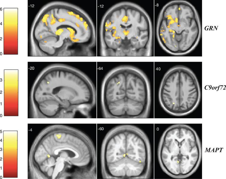 VBM analysis showing areas of significant correlation between the presence and severity of visual hallucinations and GM density across the FTD genetic groups. Statistical parametric maps were thresholded at p < 0.001 uncorrected and rendered on a study-specific T1-weighted MRI template in MNI space. Analyses were adjusted for age, gender, total intracranial volume, and scanner type. The color bar indicates the Z-scores.