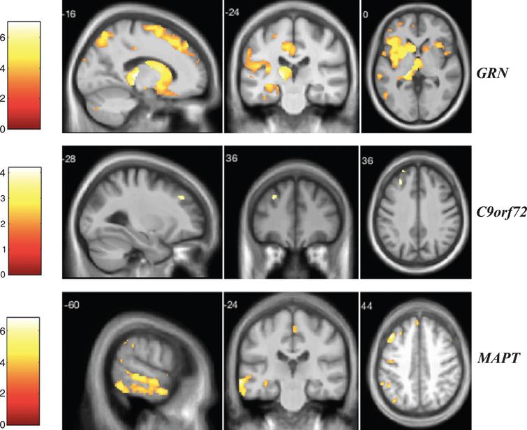 VBM analysis showing areas of significant correlation between the presence and severity of delusions and GM density across the FTD genetic groups. Statistical parametric maps were thresholded at p < 0.001 uncorrected and rendered on a study-specific T1-weighted MRI template in MNI space. Analyses were adjusted for age, gender, total intracranial volume, and scanner type. The color bar indicates the Z-scores.