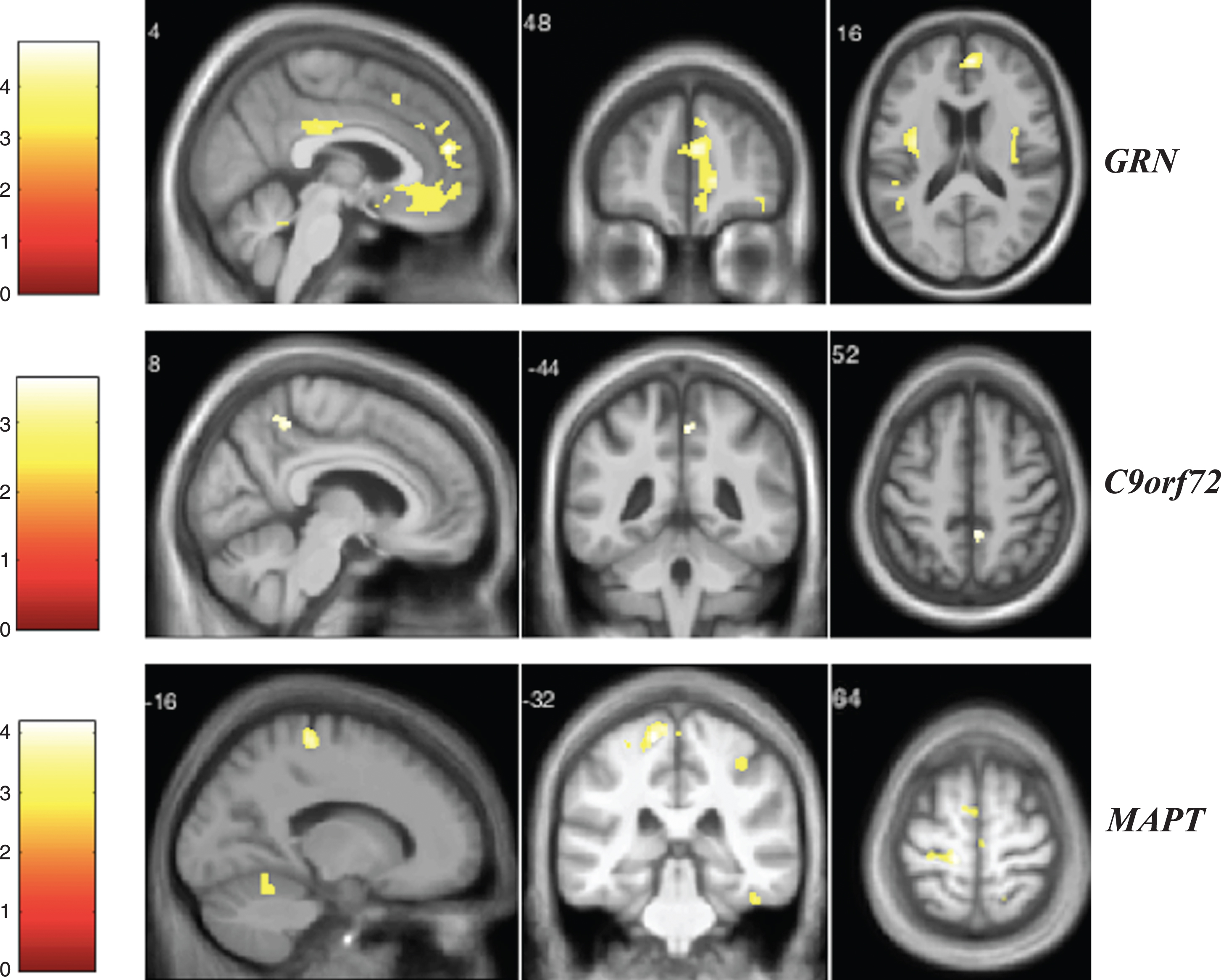 VBM analysis showing areas of significant correlation between the presence and severity of depression and GM density across the FTD genetic groups. Statistical parametric maps were thresholded at p < 0.001 uncorrected and rendered on a study-specific T1-weighted MRI template in MNI space. Analyses were adjusted for age, gender, total intracranial volume, and scanner type. The color bar indicates the Z-scores.