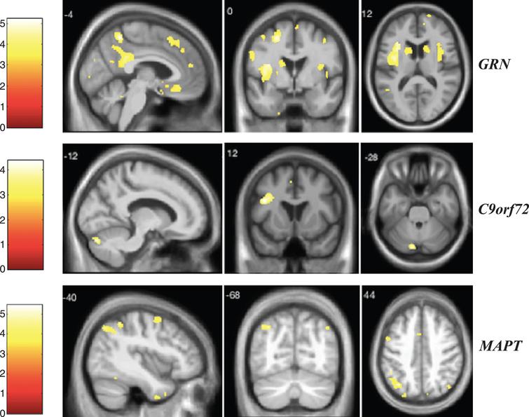 VBM analysis showing areas of significant correlation between the presence and severity of anxiety and GM density across the FTD genetic groups. Statistical parametric maps were thresholded at p < 0.001 uncorrected and rendered on a study-specific T1-weighted MRI template in MNI space. Analyses were adjusted for age, gender, total intracranial volume, and scanner type. The color bar indicates the Z-scores.