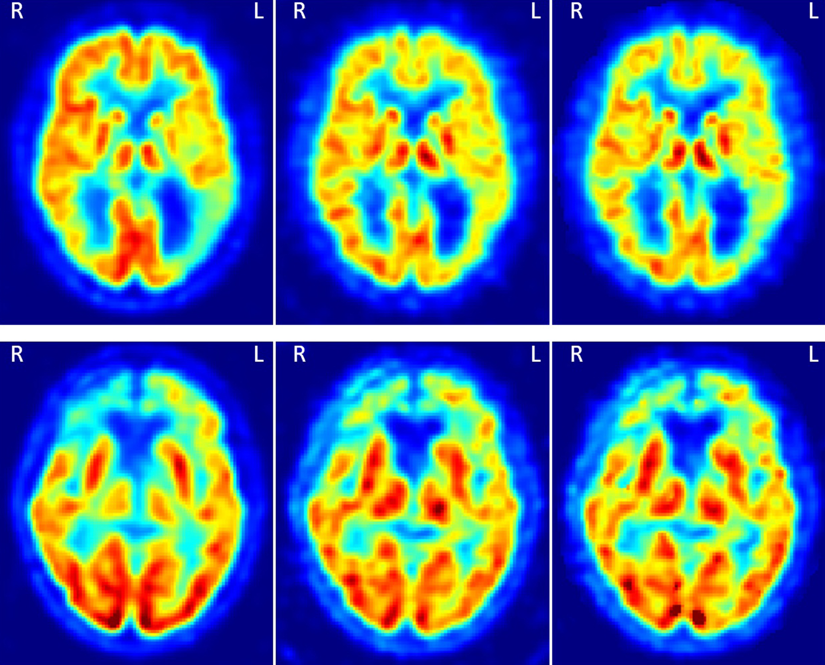 Two examples of the FDG, pPiB(1– 8min), and R1(MRTM) images, respectively from the left to the right. The images on the top are from a patient with AD, and on the bottom from a patient with FTD. In the top there is an asymmetric uptake in the parietal cortex and on the bottom an asymmetric uptake in the frontal cortex. These patterns can be seen in the three types of images.