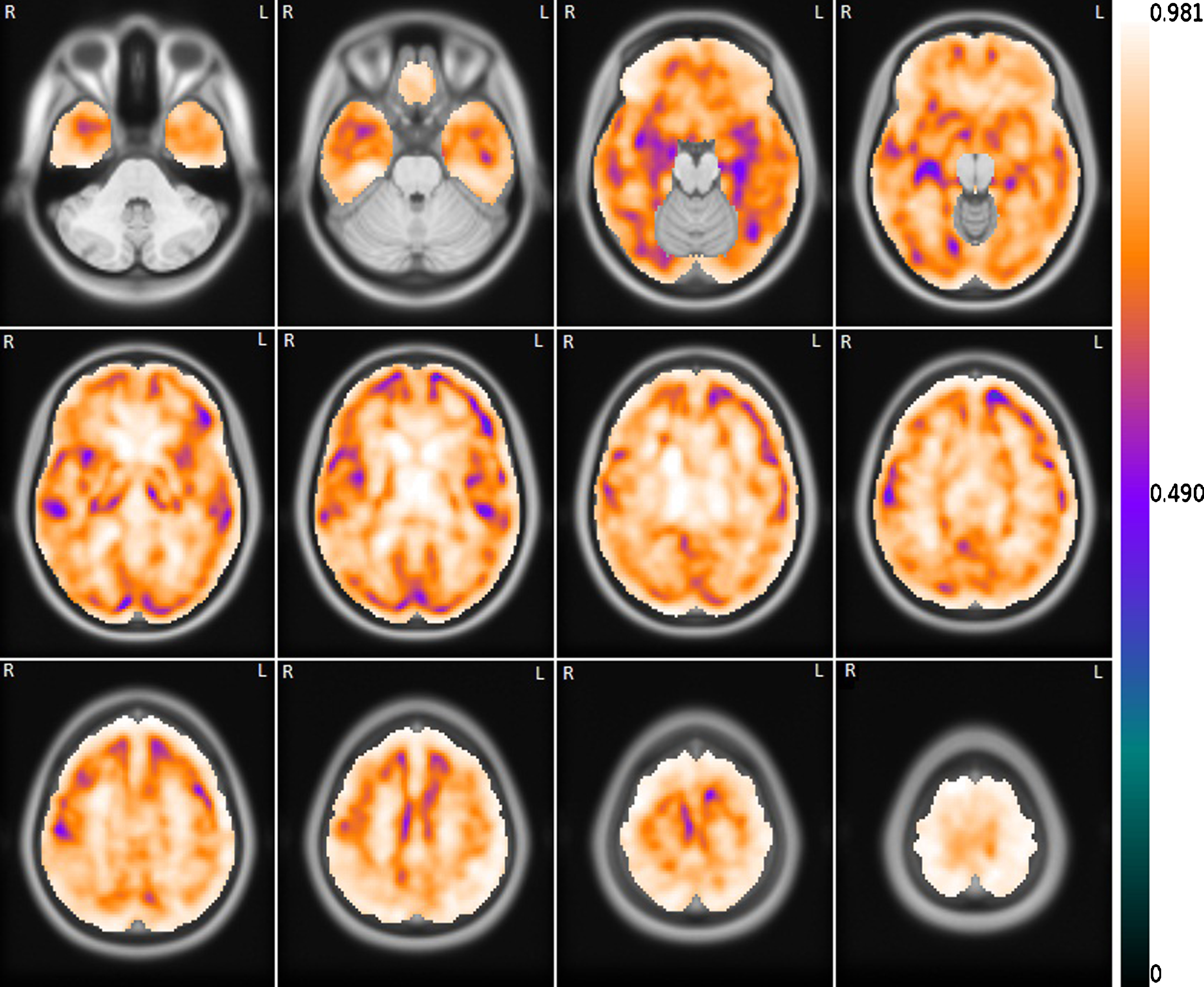 Mean voxelwise correlation between the set of FDG images and the correspondent set of R1(MRTM) images. The correlation image is overlapping the template MRI image.