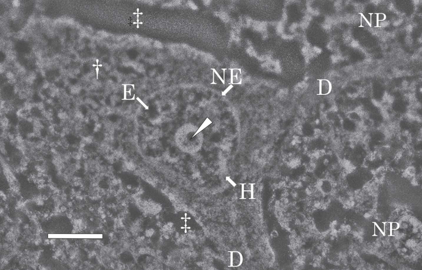 SEM micrograph of a nerve cell in the temporal cortex of the AD brain. The SEM micrograph shows a nerve cell of the AD brain fixed with potassium dichromate and stained with ammonium molybdate. The nuclear envelope (NE) shows an intact shape. Intranuclear structures such as the nucleolus, heterochromatin (H, bright region), and euchromatin (E, dark region) are well preserved. In the center of the nucleolus, pars amorpha (arrowhead) is clearly observed. Two dendrites (D) branches from the cytoplasm (dagger) of the nerve cell. Due to postmortem changes, the extracellular space (double dagger) is enlarged. NP, neuropil. Scale bar, 2μm.