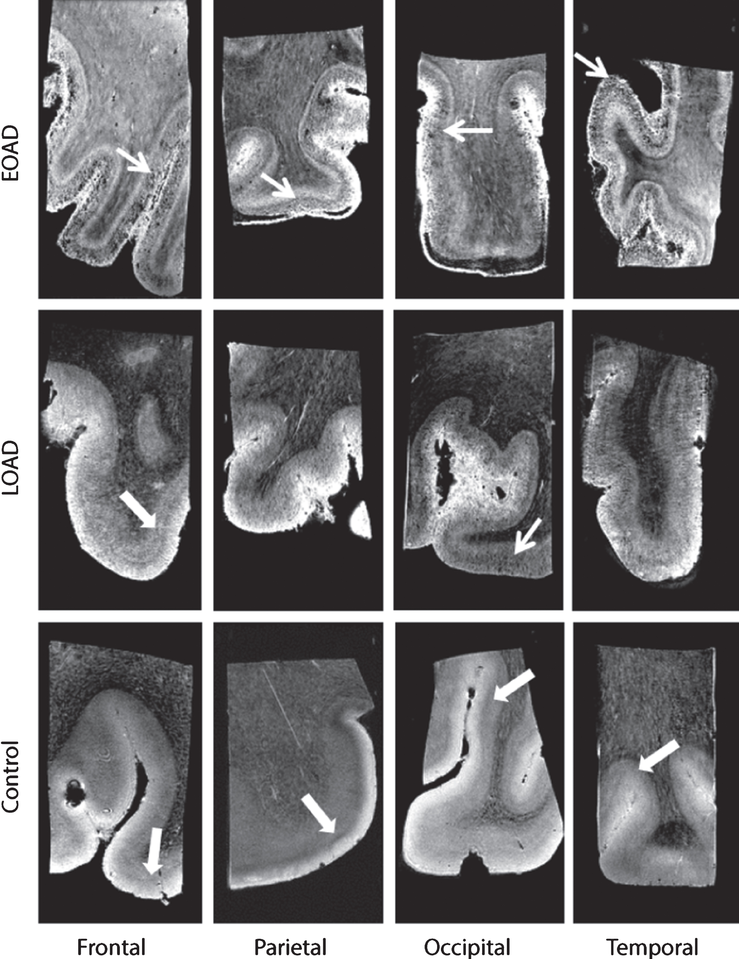 Representative MRI images of a control, LOAD, and EOAD subject. Control subjects were characterized by a normal cortex defined as a homogeneous cortex including normal cortical lamination (thick arrow). AD patients have a different cortical appearance on T2*-weighted MRI compared to control subjects. The cortex of AD patients is characterized by inhomogeneities (granular and/or patchy structure and foci of signal loss) and a diffuse hypointense band covering and obscuring the central layers of the cortex (arrow).