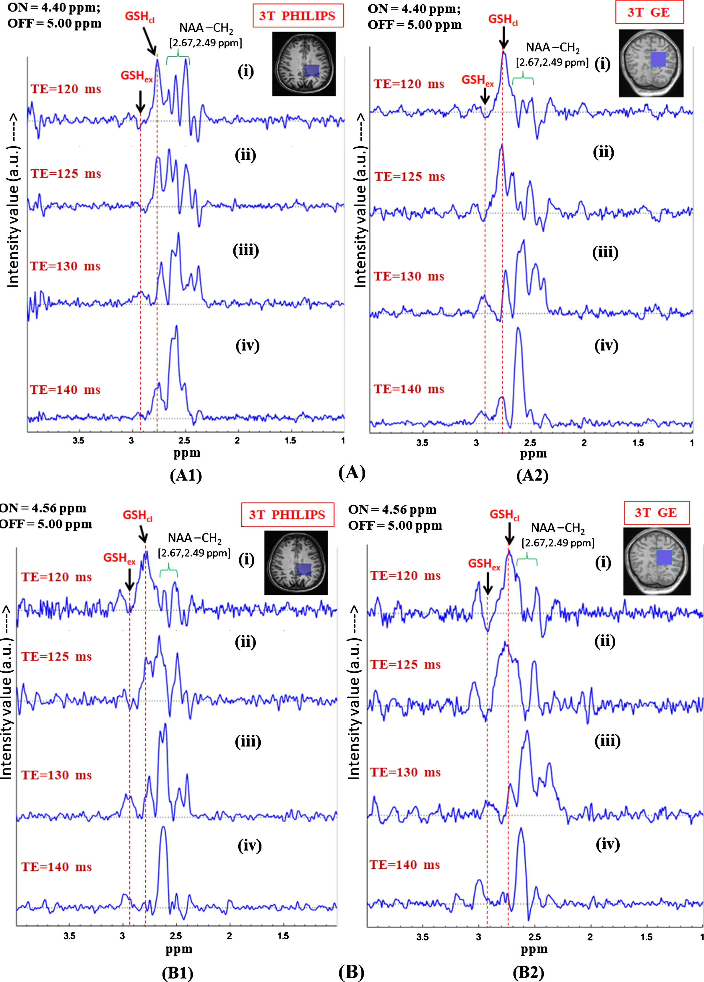 In vivo GSH conformer detection using MEGA-PRESS sequence using 3T Philips and GE scanners with the two MEGA-ON pulse positions, i.e., 4.40 ppm (A) and 4.56 ppm (B) and analysis of relative peak positions and phase of the two GSH conformation using same experimental parameters. Effect of different echo times on the two MEGA-ON pulse positions using both the Philips and GE scanners has been demonstrated for variable TE (120 ms, 125 ms, 130 ms and 140 ms) using MEGA-ON pulse at 4.40 ppm (A) and at 4.56 ppm (B). The selective excitation 180° pulse is applied at 4.40 ppm (for closed conformer) and 4.56 ppm (for extended conformer) (TE = 120 ms and TE = 125 ms give the two out of phase conformer peaks while the same two peaks appear in-phase for TE = 130 ms and TE = 140 ms. Excitation with ON-pulse at 4.40 ppm gives a sharp and heightened peak at ∼2.80 ppm and a broad peak at ∼2.95 ppm; however, ON-pulse at 4.56 ppm results in nearly equal peak shapes and area at two different positions) as the two GSH conformal peaks). The peaks are labeled as: GSHex refers to Cys-Hβ extended form; GSHcl refers to Cys-Hβ closed form; NAA-CH2 refers to NAA-Aspartate CH2 group.