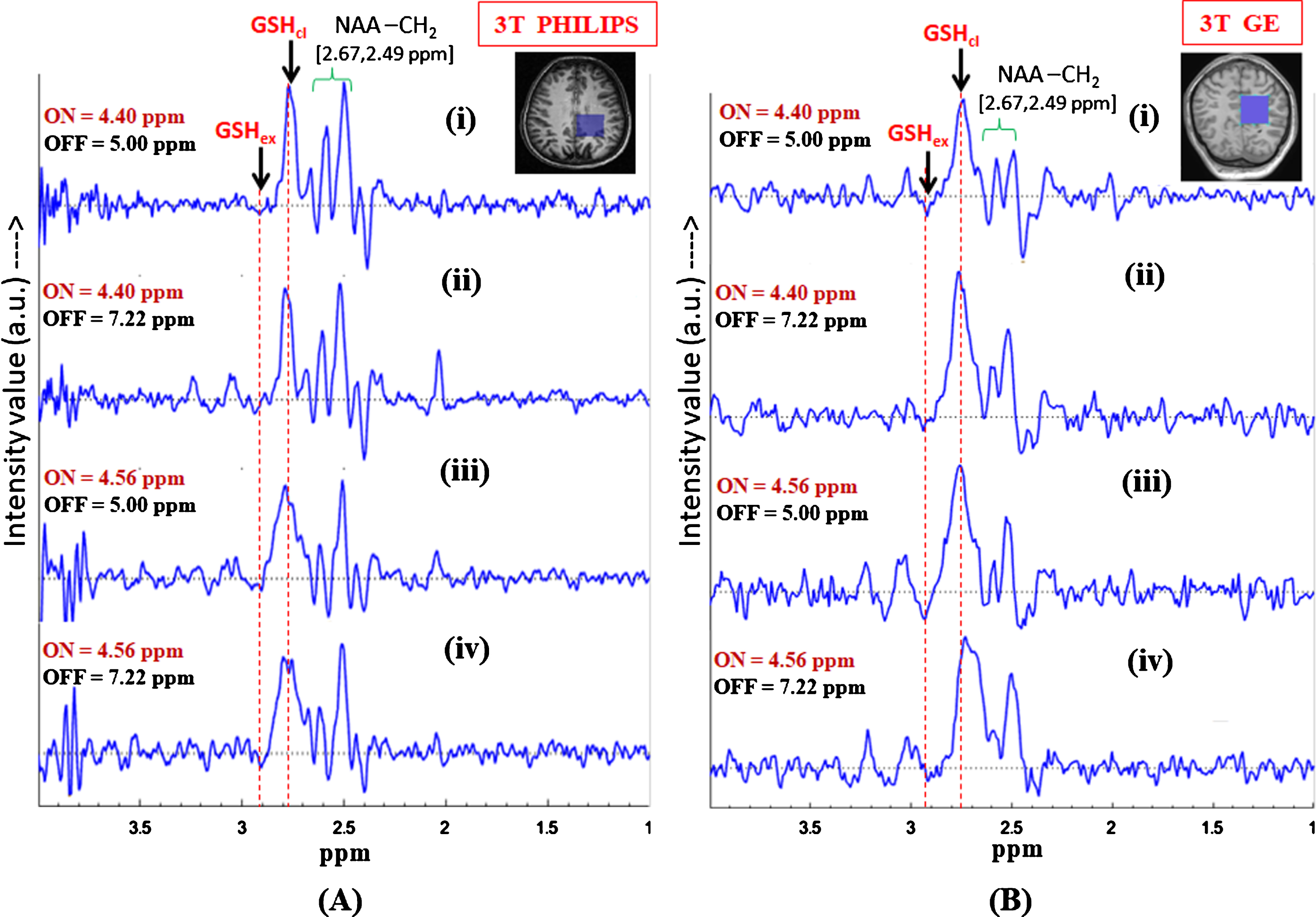Effect of inversion pulse position on the in vivo GSH conformer peak detection using MEGA-PRESS sequence. Validation of the two GSH conformal peaks in different published protocols for MEGA-ON, MEGA-OFF (ON/OFF = 4.40 ppm/5.0 ppm; 4.40 ppm/7.22 ppm; 4.56 ppm/5.0 ppm, 4.56 ppm/7.22 ppm; TE = 120 ms; TR = 2500 ms, voxel size = 3.5×3.5×3.5 cm3 on left parietal cortex) using (A) Philips scanner (Indian site) (B) GE scanner (Norwegian site) (both the peaks are present irrespective of the chosen protocols).