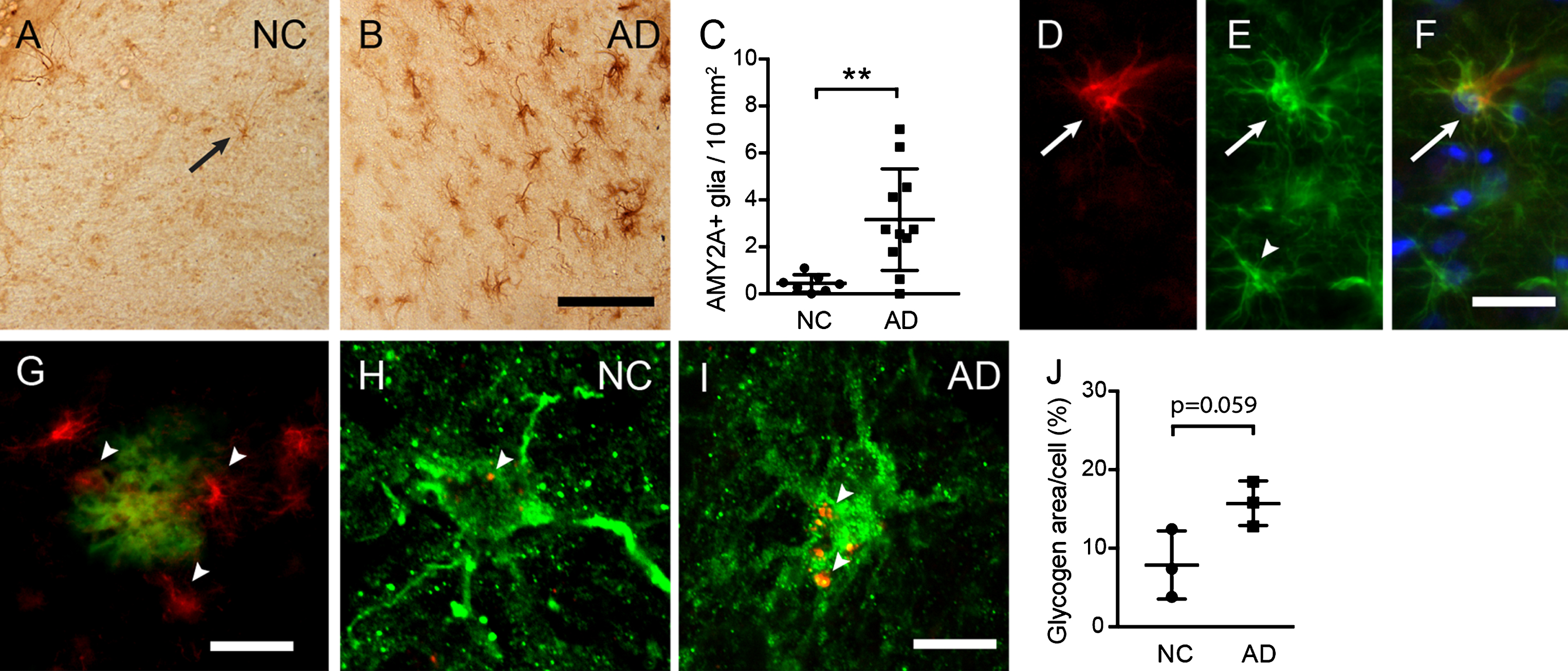 Increased astrocytic α-amylase immunoreactivity and glycogen load in AD patients. Image in (A) illustrates an AMY2A immunostaining of entorhinal cortex (EC) in a representative NC (arrow indicates an AMY2A positive glial cell). The number of strongly AMY2A+glial cells was significantly higher in AD (n = 12) compared to NC (n = 8), which is illustrated in image (B) and the column scatter plot in (C). The AMY2A glial cells (red in D) co-expressed GFAP (green in E) (D merged with E and blue DAPI staining in F) and were found primarily in astrocytes with a hypertrophic morphology (arrow in D–F), and less in astrocytes with a resting morphology (arrowhead in E). The AMY2A+glial cells (red indicated with arrowheads in G) were commonly seen adjacent to Aβ plaques (green in G). Confocal images in (H-I) demonstrate a double staining against AMY2A (in green) and glycogen (in red indicate with arrowheads in H and I), where the glycogen load in NC (H) is less pronounced compared to AD (I). The column scatter plot in (J) shows an on boarder significant increase of glycogen area/cell percentage in AMY2A+cells (n = 5) of AD patients (n = 3) (in total 15 cells) compared to glycogen area/cell in AMY2A+cells (n = 5) of NC (n = 3) (in total 15 cells). Data was analyzed using student t-test and presented as mean±SD. **p > 0.01. Scalebar A and B = 40, D–F = 15, G = 25, H and I = 5r μm.