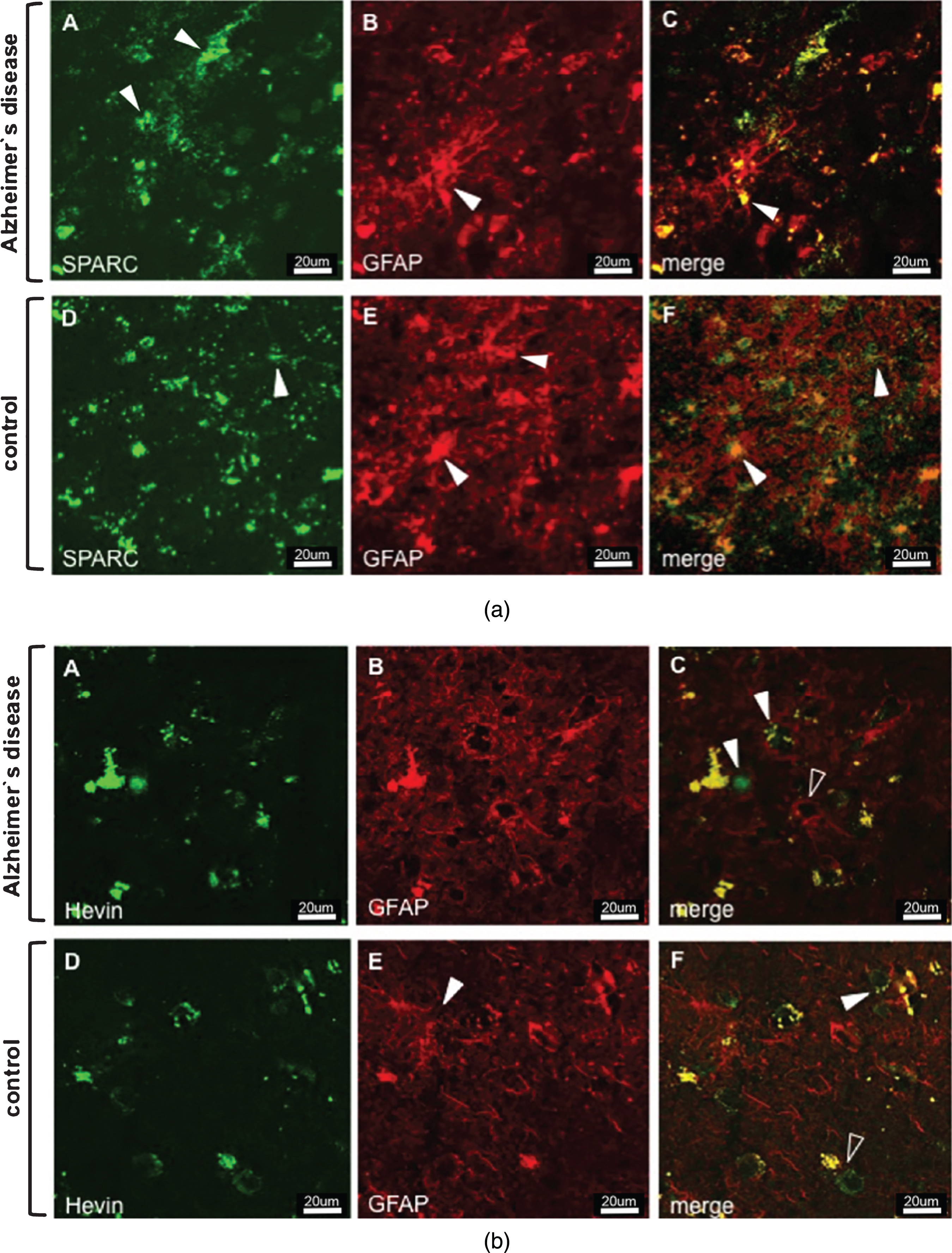 a) Immunostaining of SPARC and astrocytes in AD (images A–C) and control tissue (images D–F). Series A–C depicts increased AD-associated SPARC expression as compared to control tissue. The extracellular distribution of SPARC (arrowheads in A) is not associated with reactive AD astrocytic GFAP expression (arrowhead in B). Images D–F show that extracellular SPARC (arrowhead in D) is not associated with quiescent control astrocytes (arrowheads in E). Lipofuscin fluoresces in both the red and green channels and appears yellow in the merged images (arrowhead in G and F). b) Immunostaining of Hevin and astrocytes in AD (images A–C) and control tissue (images D–F). Hevin is expressed to a lesser extent in AD samples and is clearly not associated with astrocytic activity, cf. arrowheads in image C. Instead, astrocytes seem to gather around neurons (arrowhead, image C) and blood vessels (open arrowhead, image C). Control tissue has distinct Hevin positive cells that are likely to be neurons (arrowhead, image F) and other cell types (open arrowhead, image F). Yellow structures in C and F are lipofuscin in degenerate neurons or extracellular deposits.