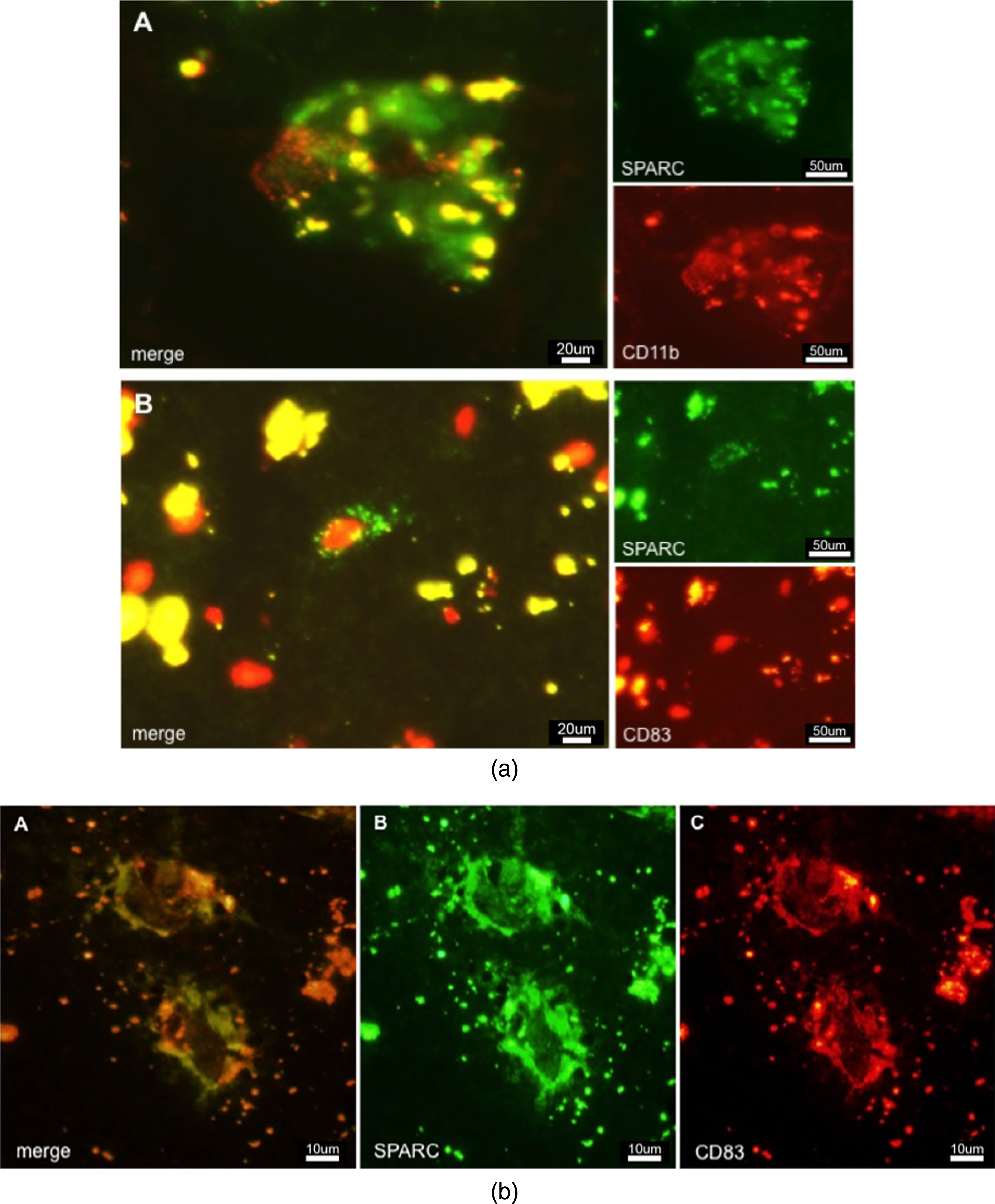 a) Immunostaining of SPARC positive cells in AD tissue. A: CD11b positive macrophages colocalized and associated with SPARC expression. B: CD83 positive cell expressing SPARC. b) Colocalization of SPARC and CD83, demonstrating the ability of dendritic cells to induce SPARC expression. This image shows the diseased state. Controls (not shown) do not exhibit such expression patterns.