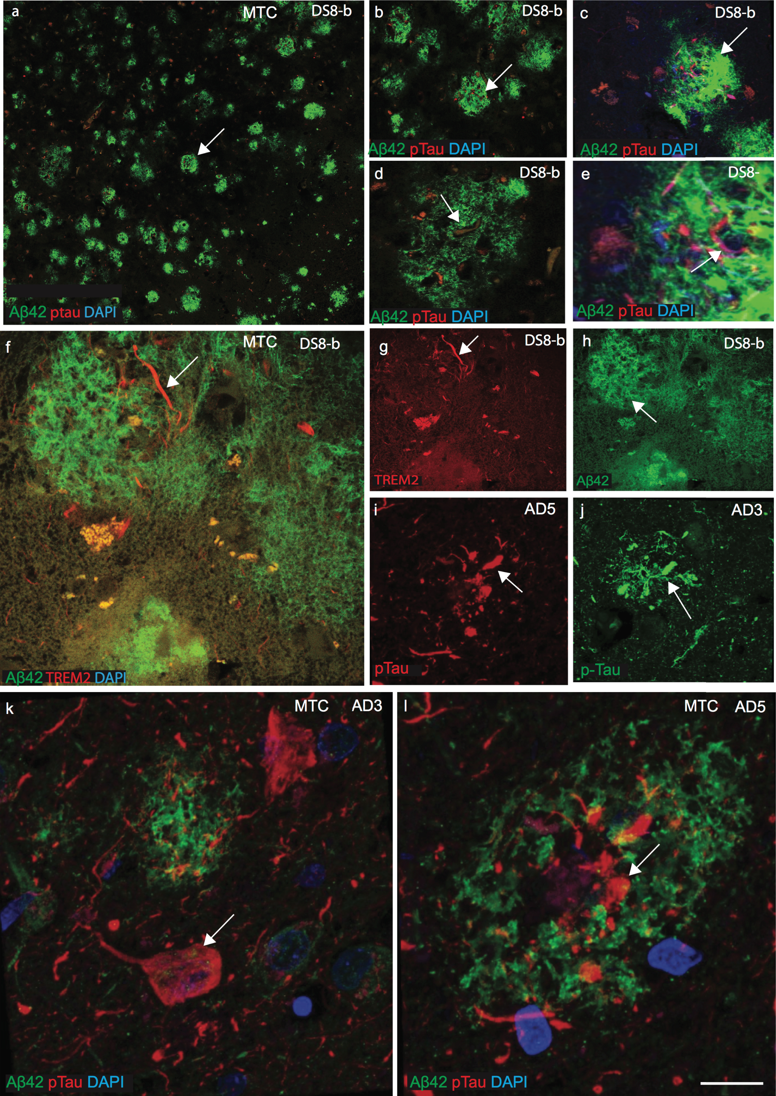 TREM2 and tau proteins did not co-localize with Aβ42 senile plaques in mid temporal cortex. Double immunofluorescence staining and confocal images were performed on the mid temporal cortex (MTC) of AD and DS brain sections using rabbit monoclonal anti-Aβ42 (rab-mAb Aβ42, green) and mAb anti-phospho-tau (AT8, red) antibody, DAPI for nuclear staining (Blue). Aβ42 immunoreactivity was visible in the senile plaques (SPs) but did not co-localize with p-Tau (a–e). In DS brain (DS8), the layer III of MTC stained for anti-Aβ42 (green) and showed many mature plaques (f and h). TREM2 was only present around the SPs and visible in the neuropil thread (f and g). Further staining of different cases of AD (AD3 and AD5, Supplementary Table 1) and images was captured by confocal microscopy, showed that mature Aβ42 positive SPs did not co-localize with p-Tau positive neurofibrillary tangles. Scale bar in a–c = 50 μm, d-k = 25 μm, and l = 10 μm.