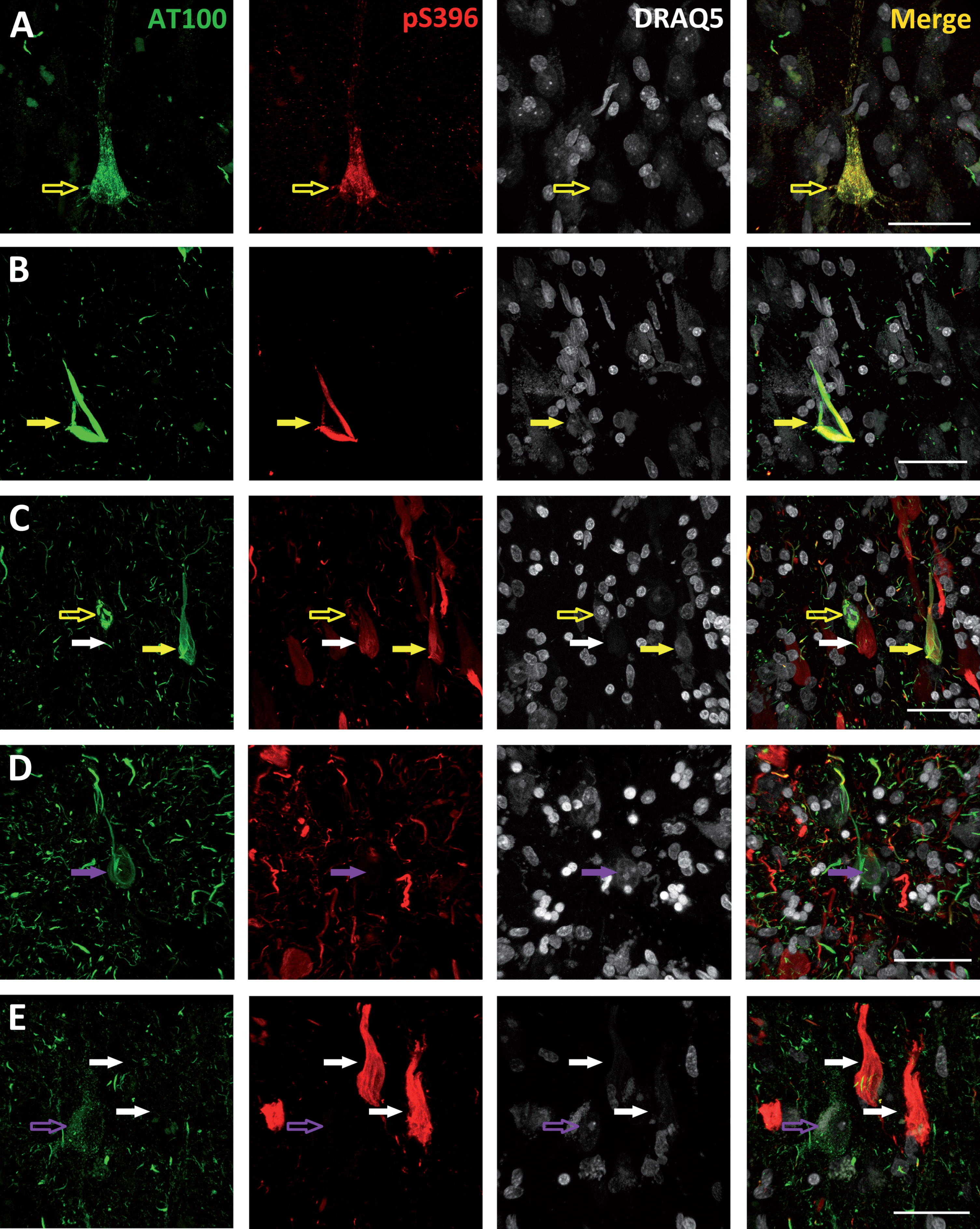 Photomicrographs belonging to cases with Braak stage I (A), III (B), and VI (C, D, and E) illustrating the different patterns of AT100 (green), pS396 (red), and DRAQ5 (grey) labeling found. Empty arrows indicate neurons with a granular staining—either AT100 positive (empty purple arrows) or both AT100 and pS396 positive (empty yellow arrows). Filled arrows indicate NFTs: AT100 positive (purple arrows), pS396 positive (white arrows), or AT100 and pS396 positive (yellow arrows). Higher magnification of panels in Supplementary Figs. 1–5. All scale bars: 40 μm.
