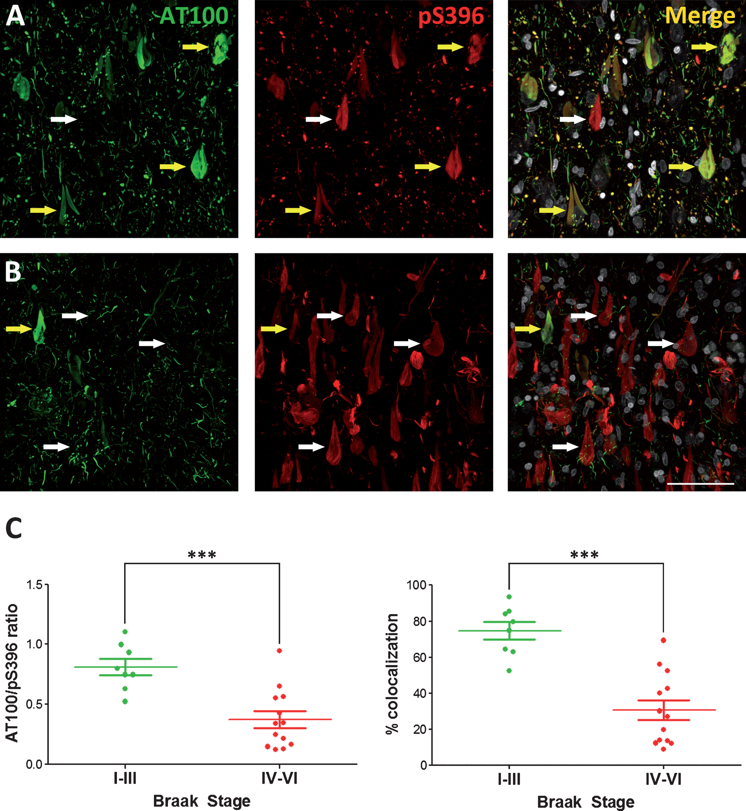 Representative photomicrographs showing the pattern of both AT100 and pS396 immunostaining in cases with low (I−III) (A) or high (V−VI) (B) Braak Stages. White arrows mark examples of neurons presenting no colocalization, whereas yellow arrows mark double-labeled neurons. (C) Histograms show the AT100/pS396 labeling ratio (left) or the colocalization percentage (right) in all the cases examined in this study grouped by low or high Braak Stage. A paired t test found significant differences in the comparisons between low and high Braak stages for both AT100/S396 ratio and colocalization (mean ± SD). ***p < 0.0005. Scale bar: 60 μm.