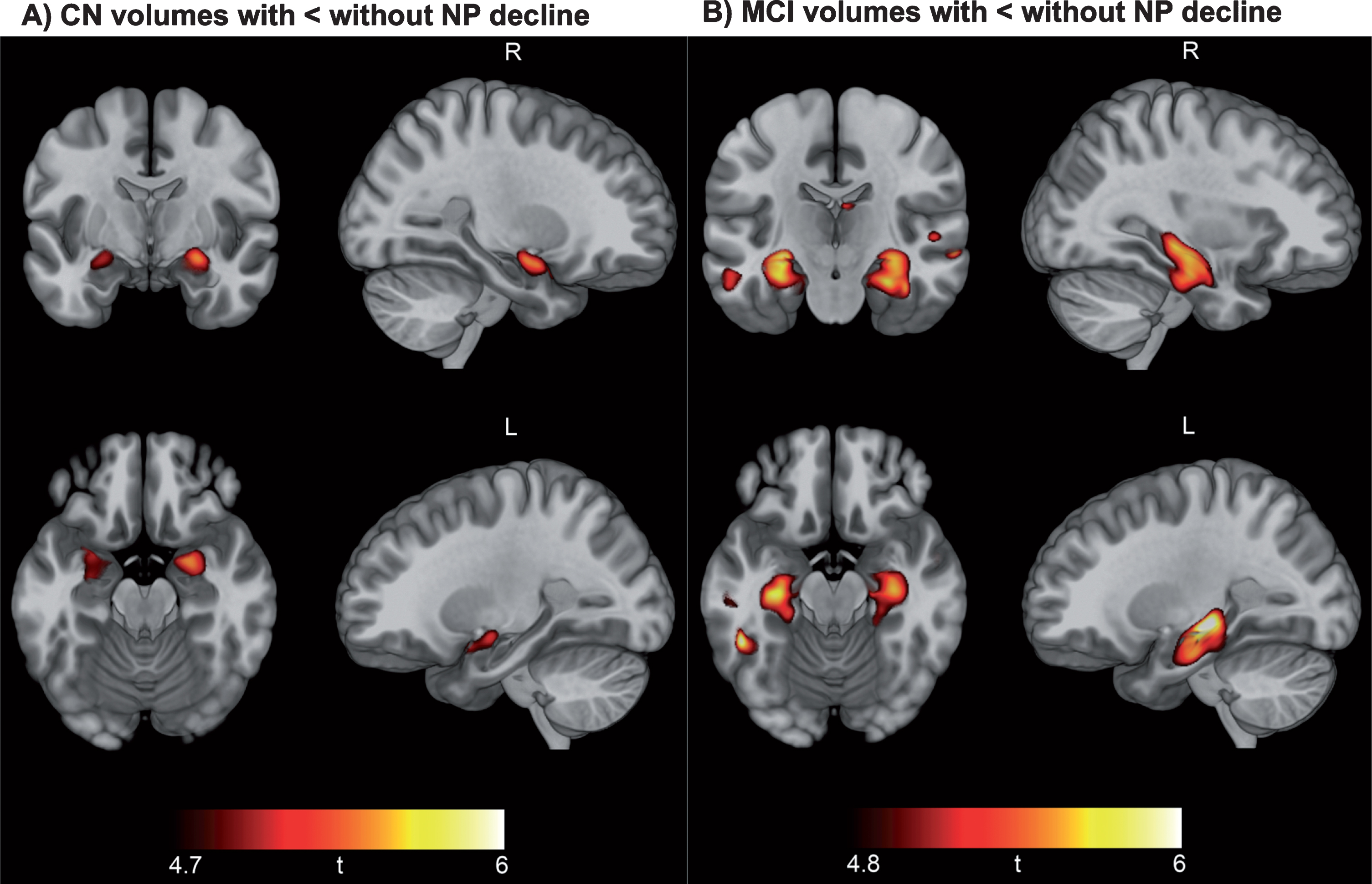 Neuropsychological decline linked to baseline hippocampal and medial temporal lobe volume. Results of voxel-based morphometry analysis after FWE correction are displayed as t-maps overlaid onto a template T1 image for anatomical reference. Findings from two-sample t-tests show a consistent pattern of smaller hippocampal volume in CN participants with NP decline versus CN without NP decline (A) and smaller hippocampal and medial temporal volume in MCI patients with NP decline versus MCI without NP decline (B).