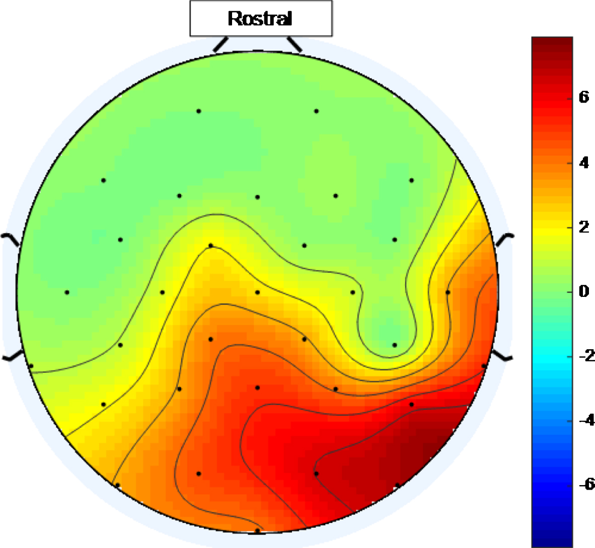 Scalp map for low intensity 40 Hz stimulus for healthy volunteer 1. Areas represented by colors above 0 on the color bar represent a 40 Hz entrainment response with values that are higher on the color scale having 40 Hz peaks that are higher above the average PSD value in the 25 Hz–45 Hz range.