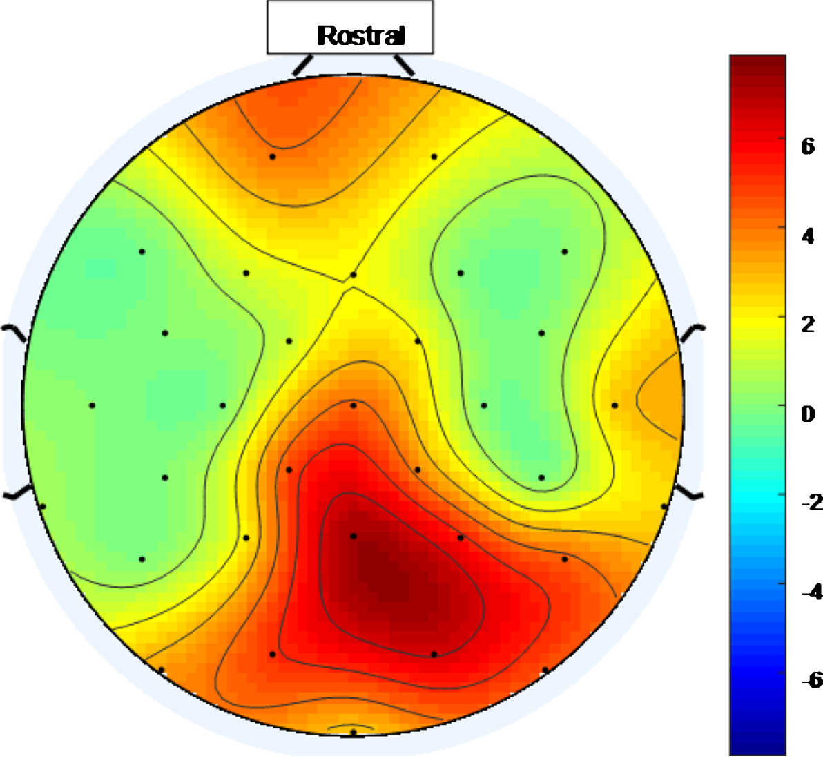Scalp map for high intensity 40 Hz stimulus for healthy volunteer 1. Areas represented by colors above 0 on the color bar represent a 40 Hz entrainment response with values that are higher on the color scale having 40 Hz peaks that are higher above the average PSD value in the 25 Hz–45 Hz range.