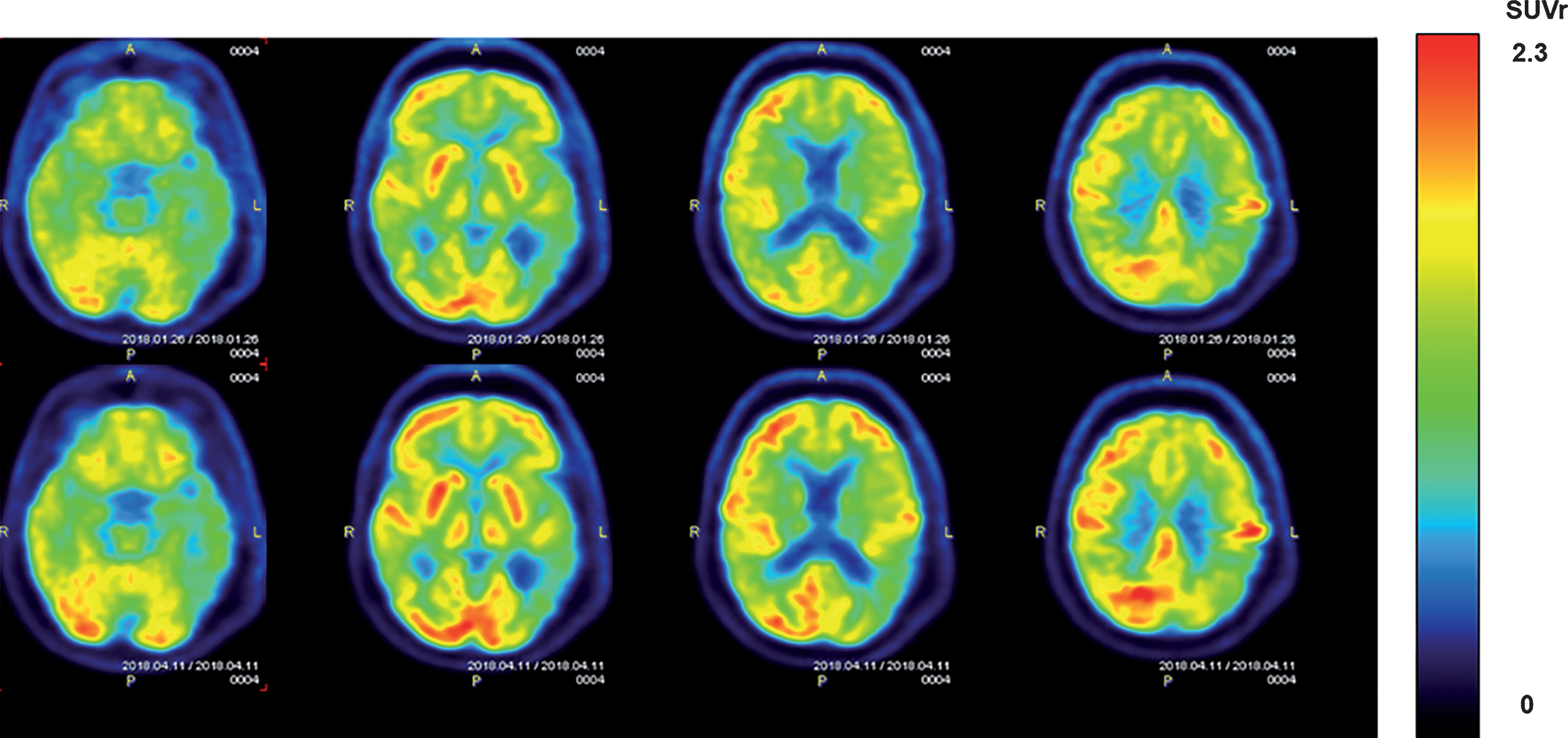 FDG-PET scans from an AD subject showing cerebral metabolic rate for glucose (CMGgl) in four horizontal levels. The upper scans were taken at baseline, with corresponding lower scans taken at the same level following 2 months of daily TEMT. Note higher FDG-PET intensity after TEMT throughout the forebrain (especially in the left hemisphere), as evidenced by more prevalent red/orange areas.
